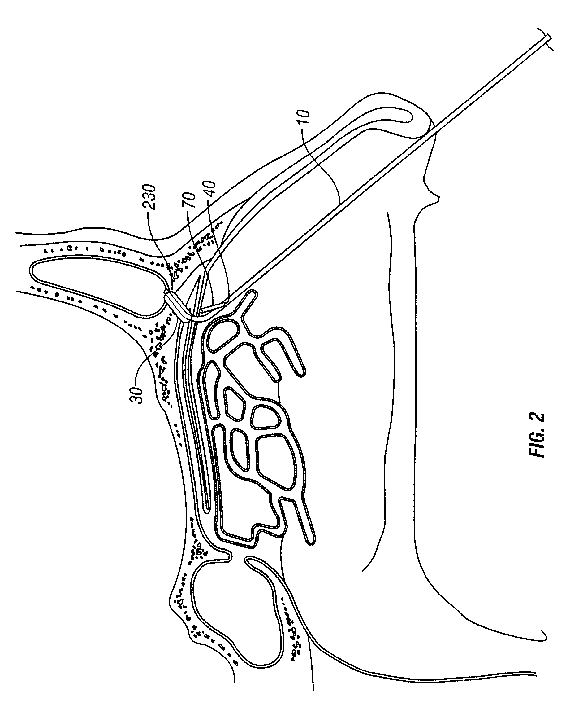 Multi-lumen catheter and endoscopic method