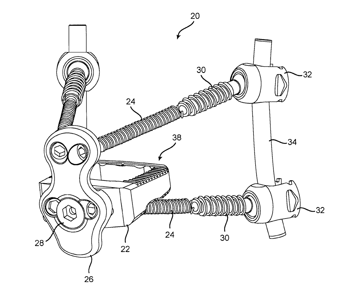 Three column spinal fixation implants and associated surgical methods