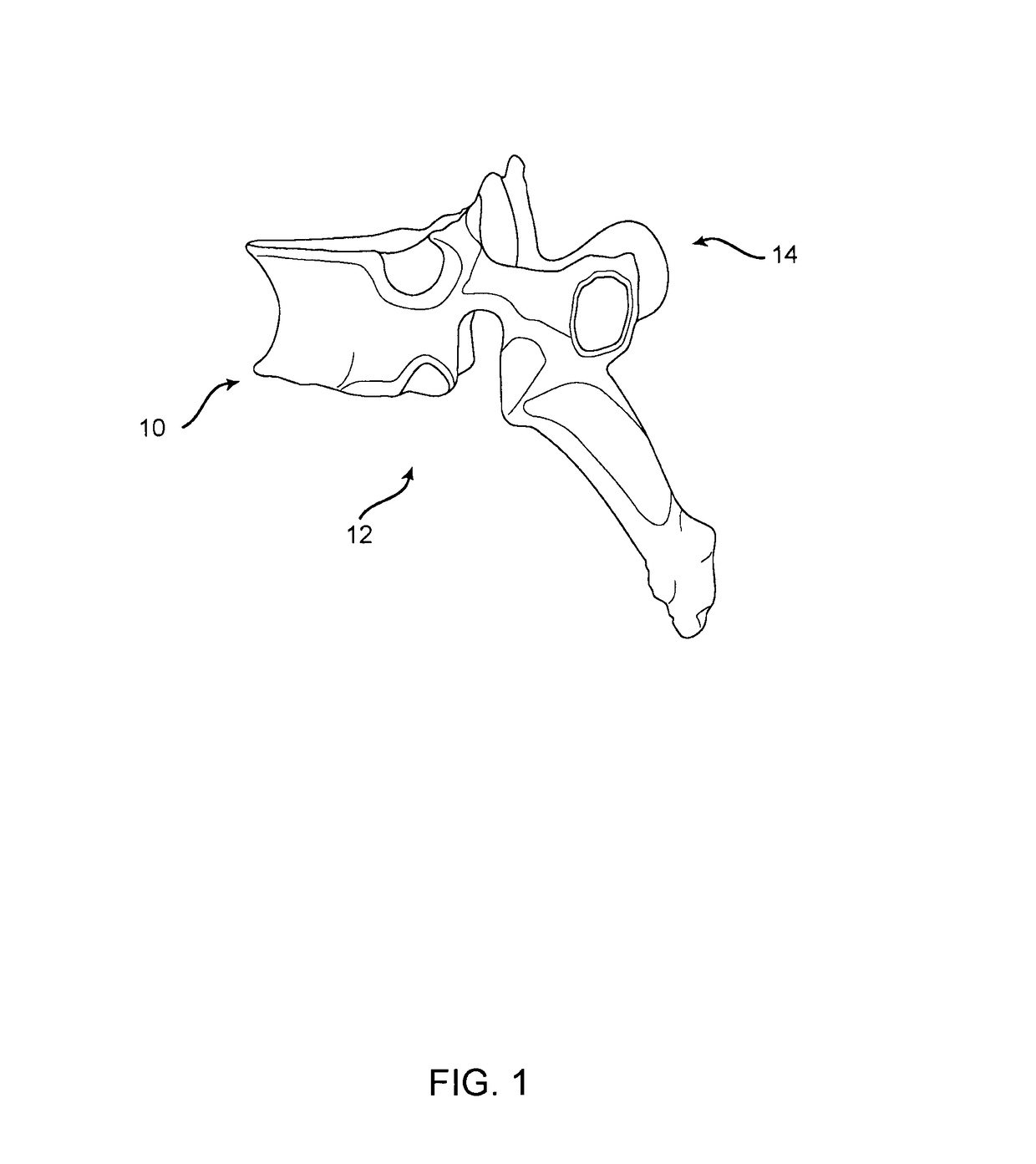 Three column spinal fixation implants and associated surgical methods