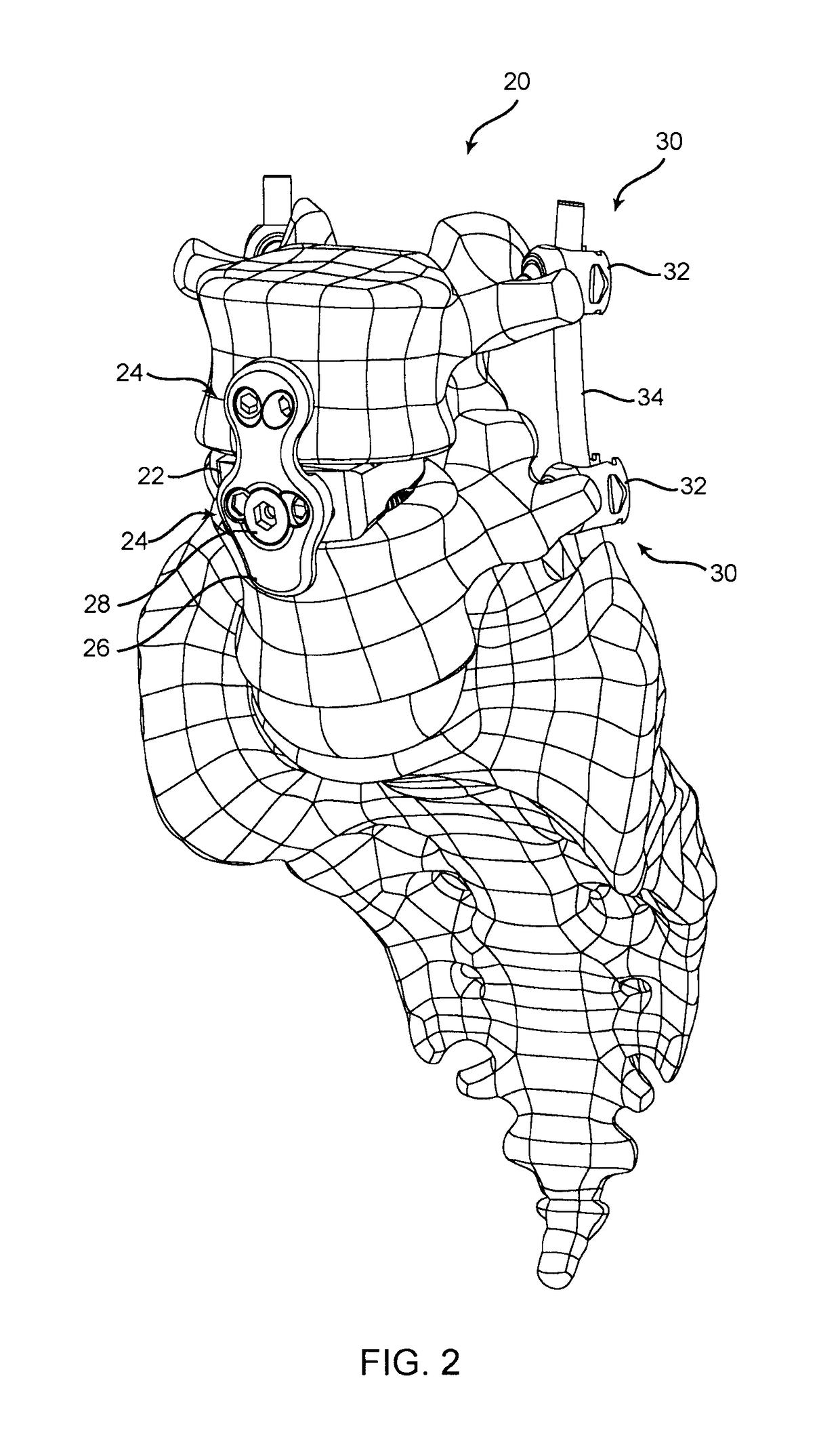 Three column spinal fixation implants and associated surgical methods