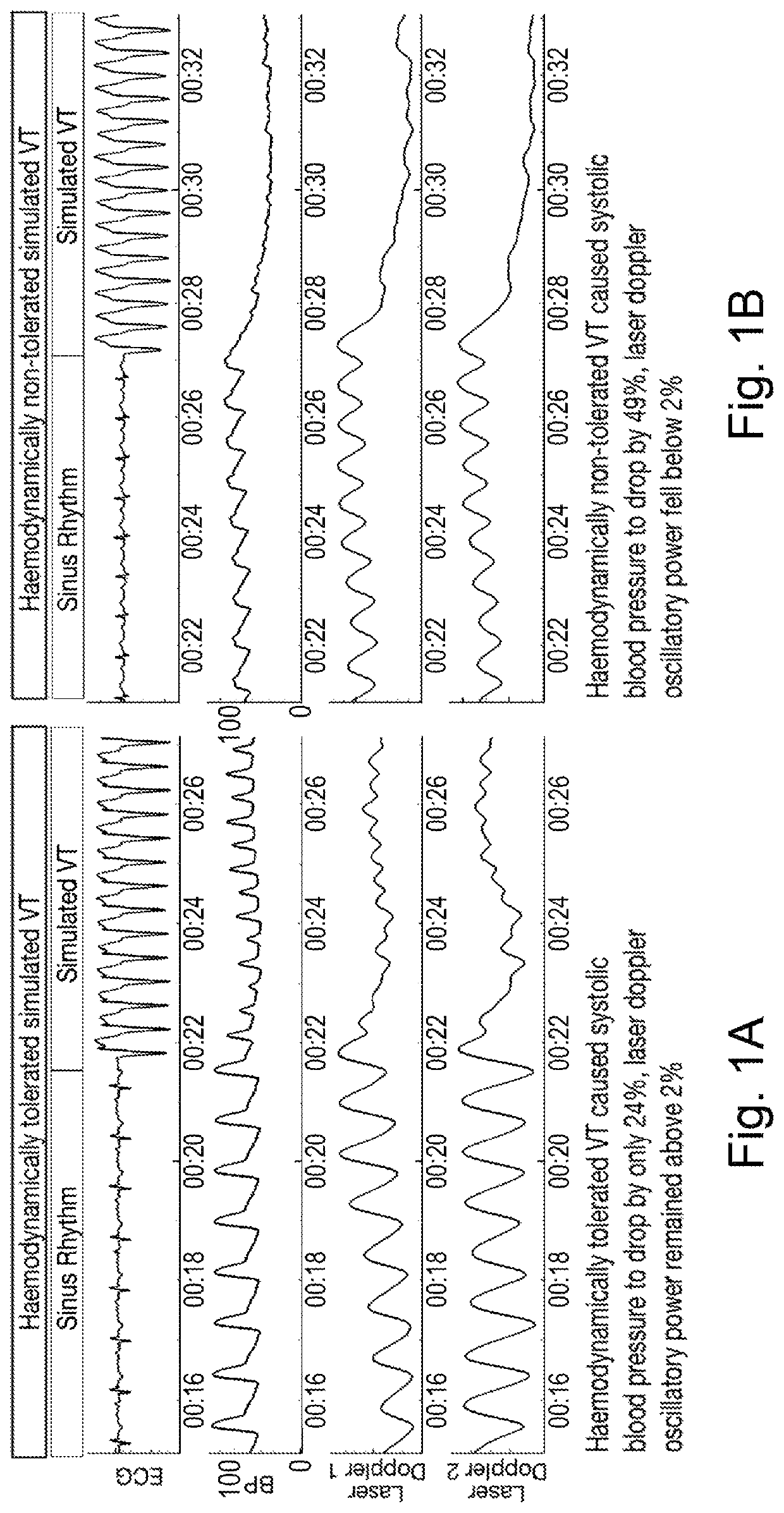 Method and an apparatus for determining hemodynamic status