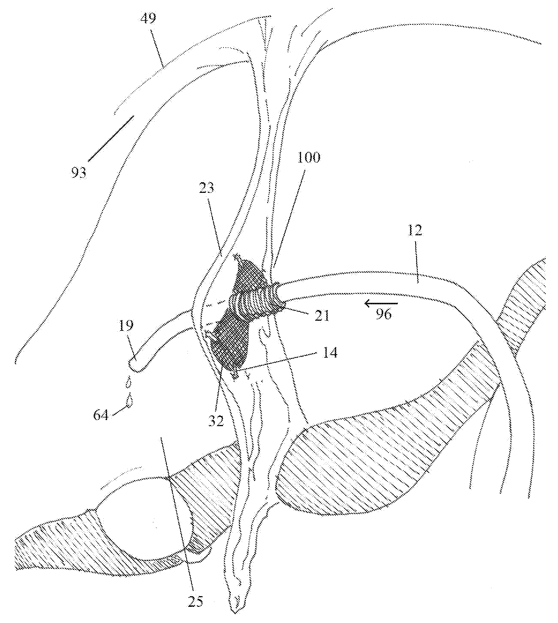 Securement device for shunt catheter and implantation method therefor