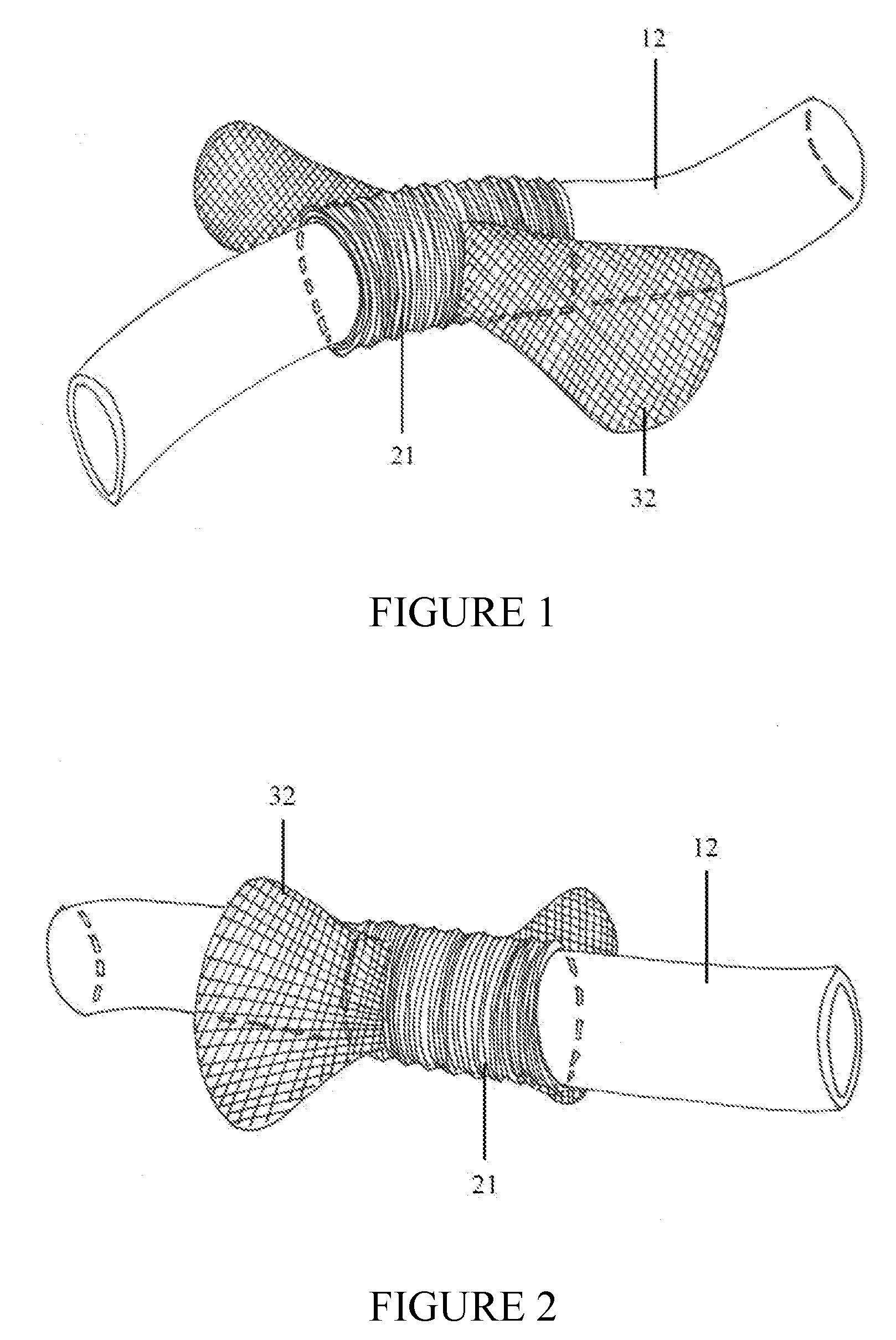 Securement device for shunt catheter and implantation method therefor