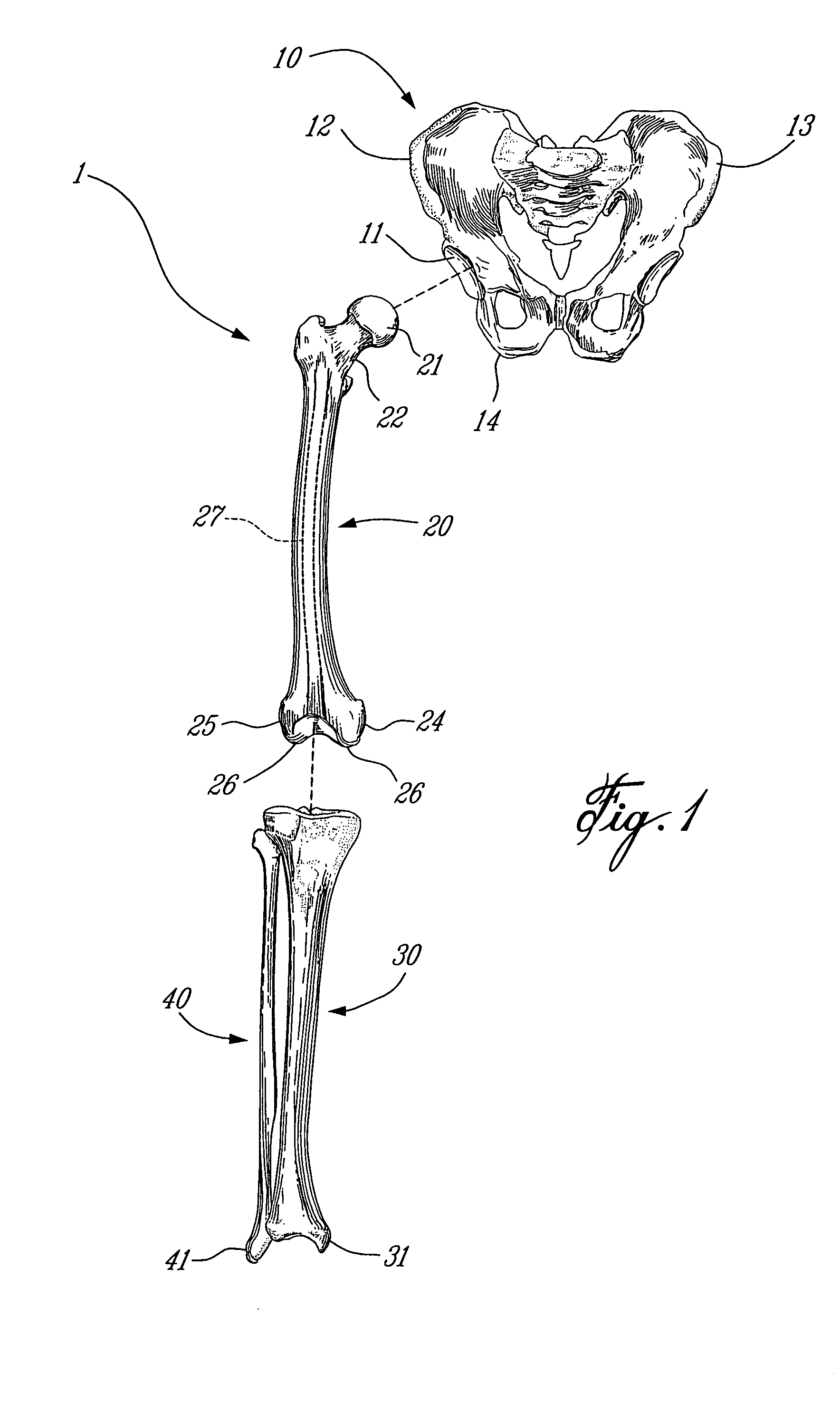 Apparatus for digitizing intramedullary canal and method