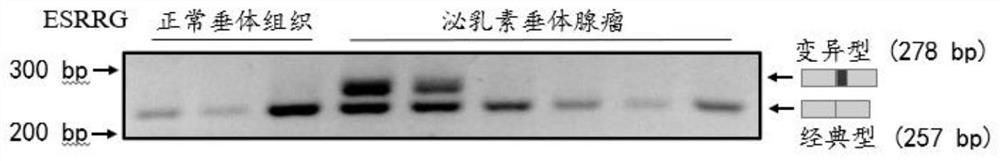 Application of estrogen receptor related receptor gamma (ESRRG) variant transcript in auxiliary diagnosis of pituitary adenoma