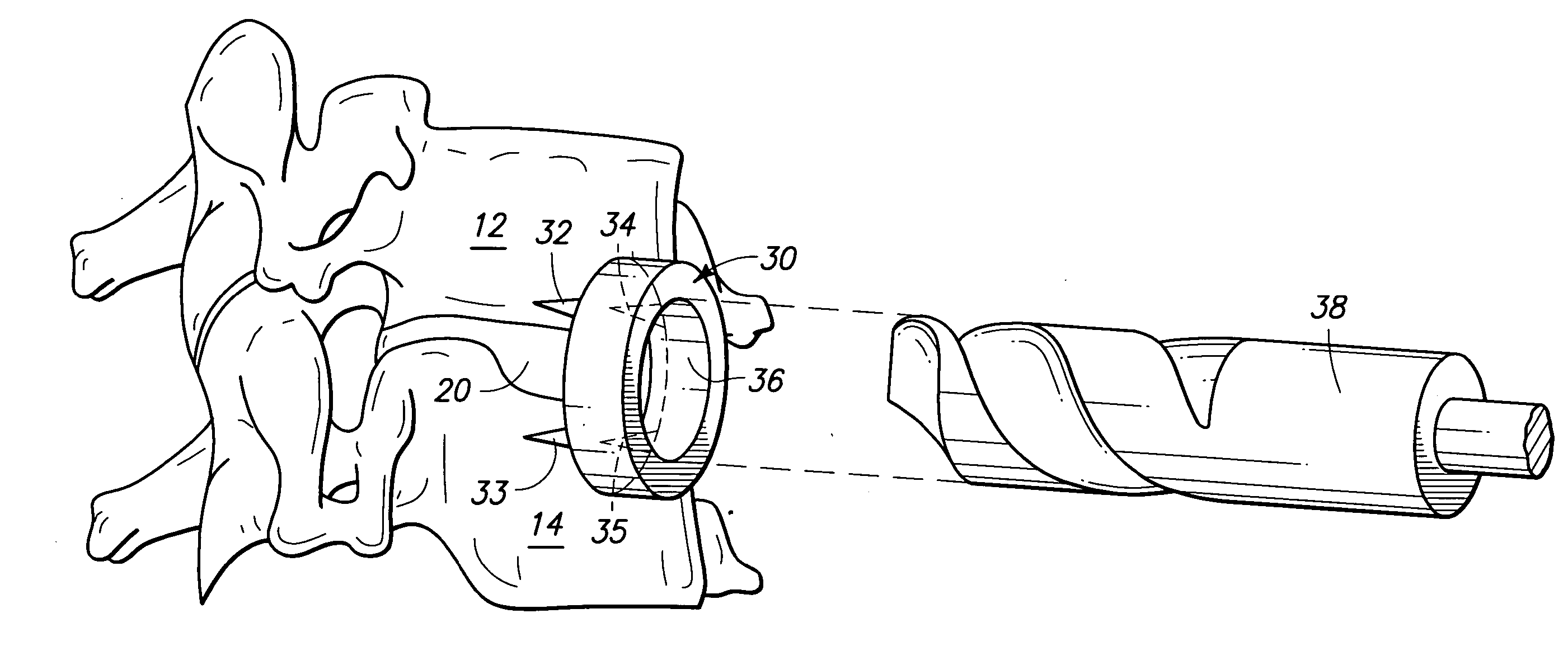 Apparatus and method for preparing a spinal implant surgical site for receiving a spinal fusion implant