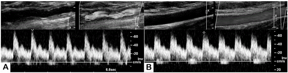 Artificial blood vessel and preparation method thereof