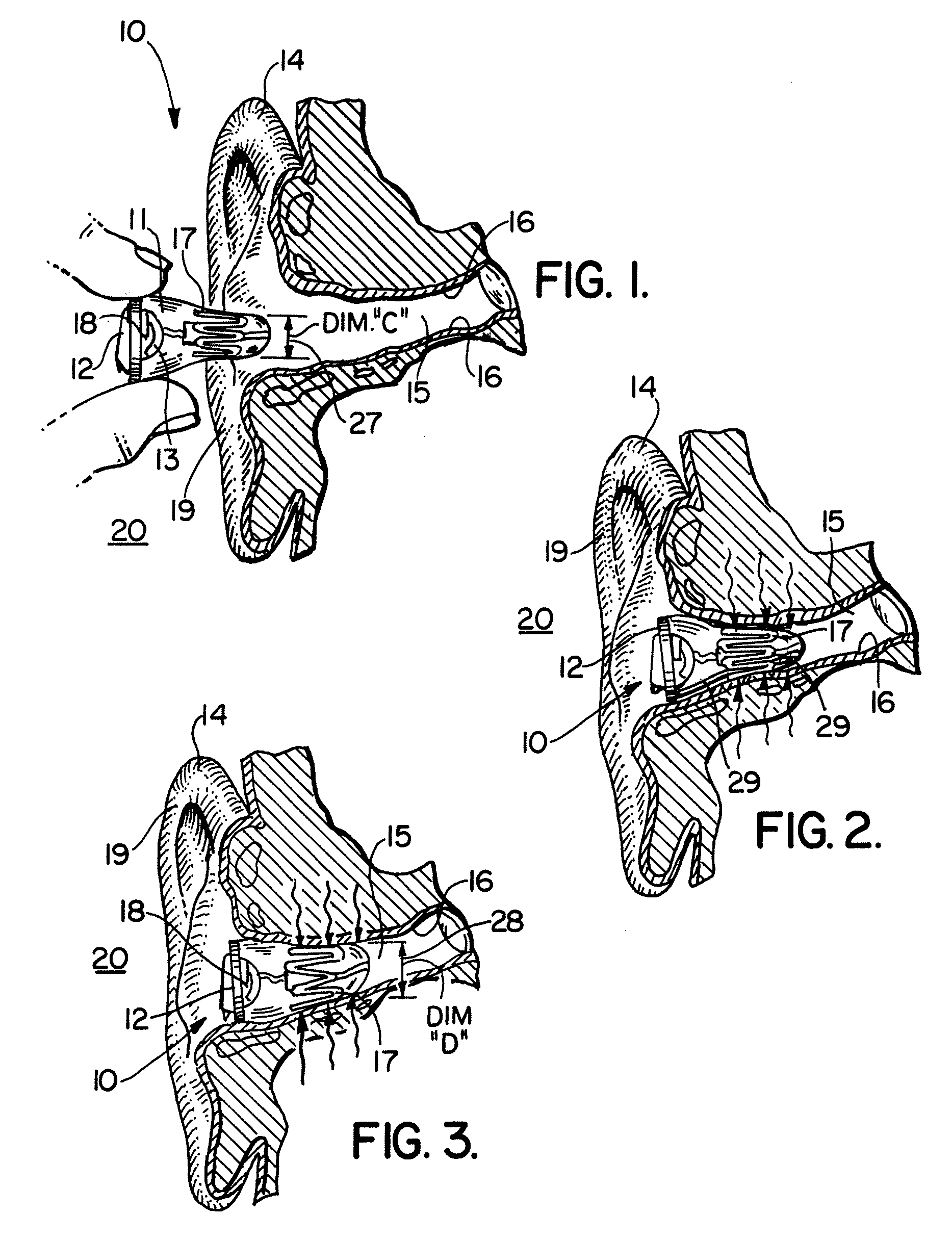 Self forming in-the-ear hearing aid with conical stent