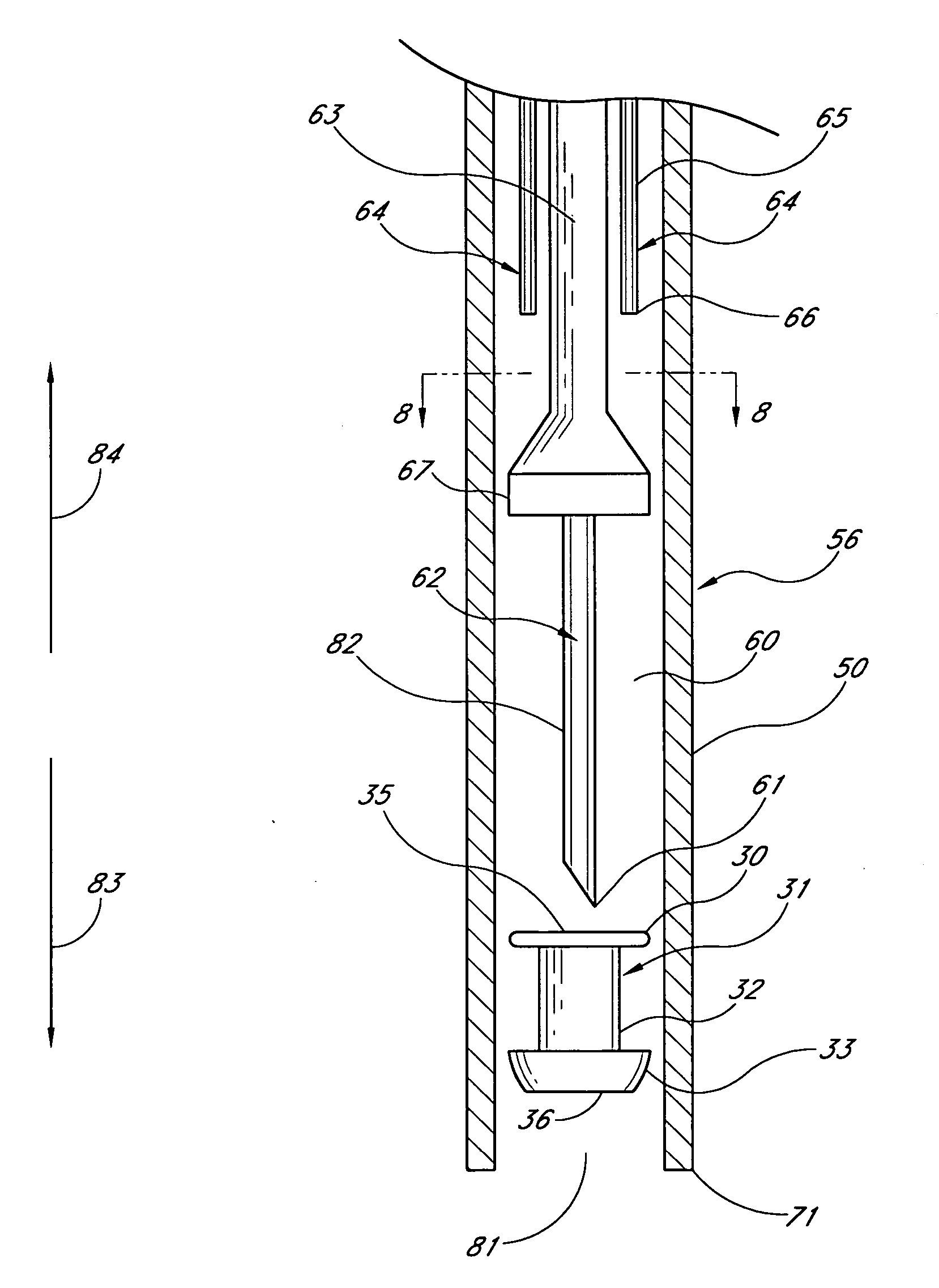 Glaucoma stent system