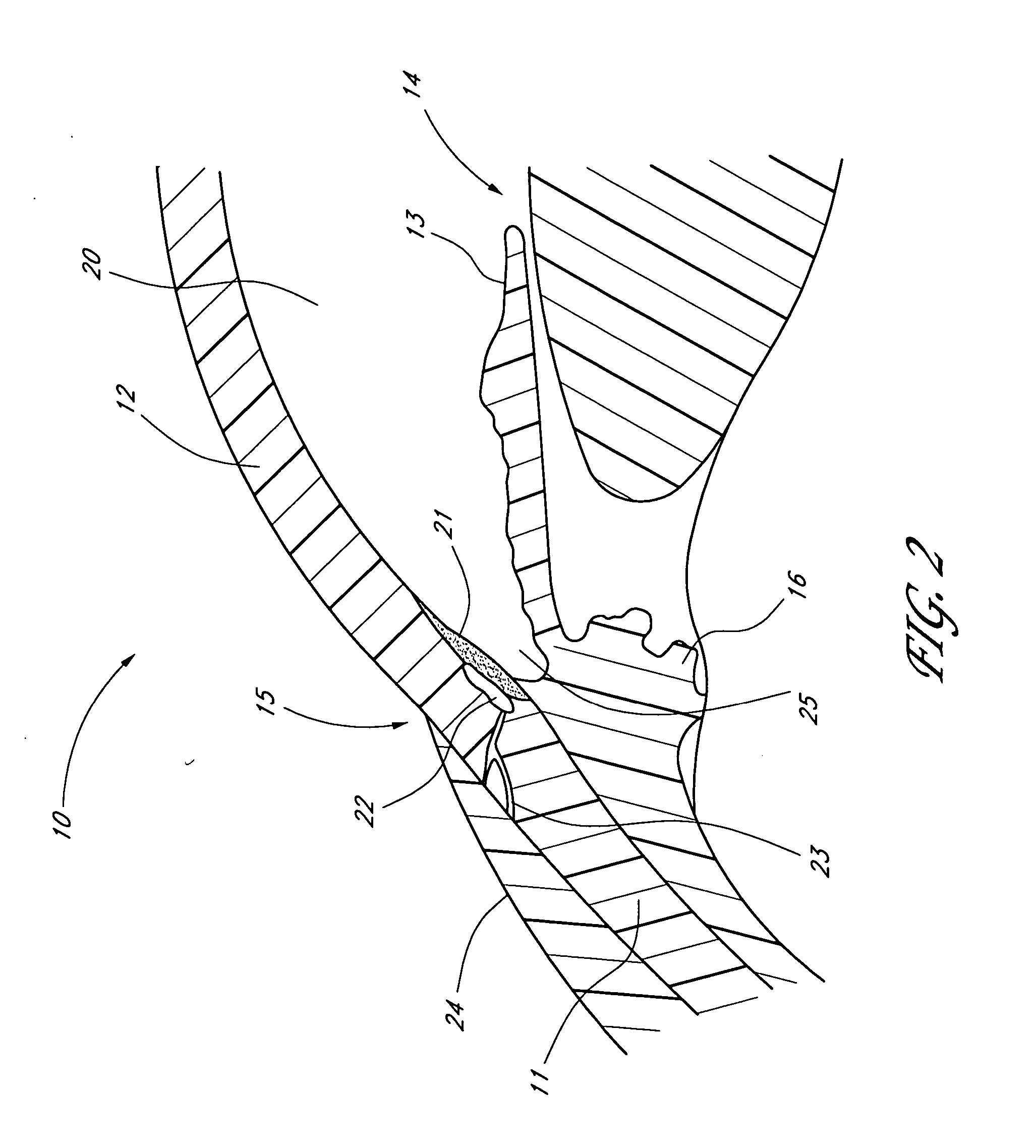 Glaucoma stent system