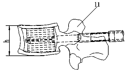 Stacking-type full-height centrum forming device