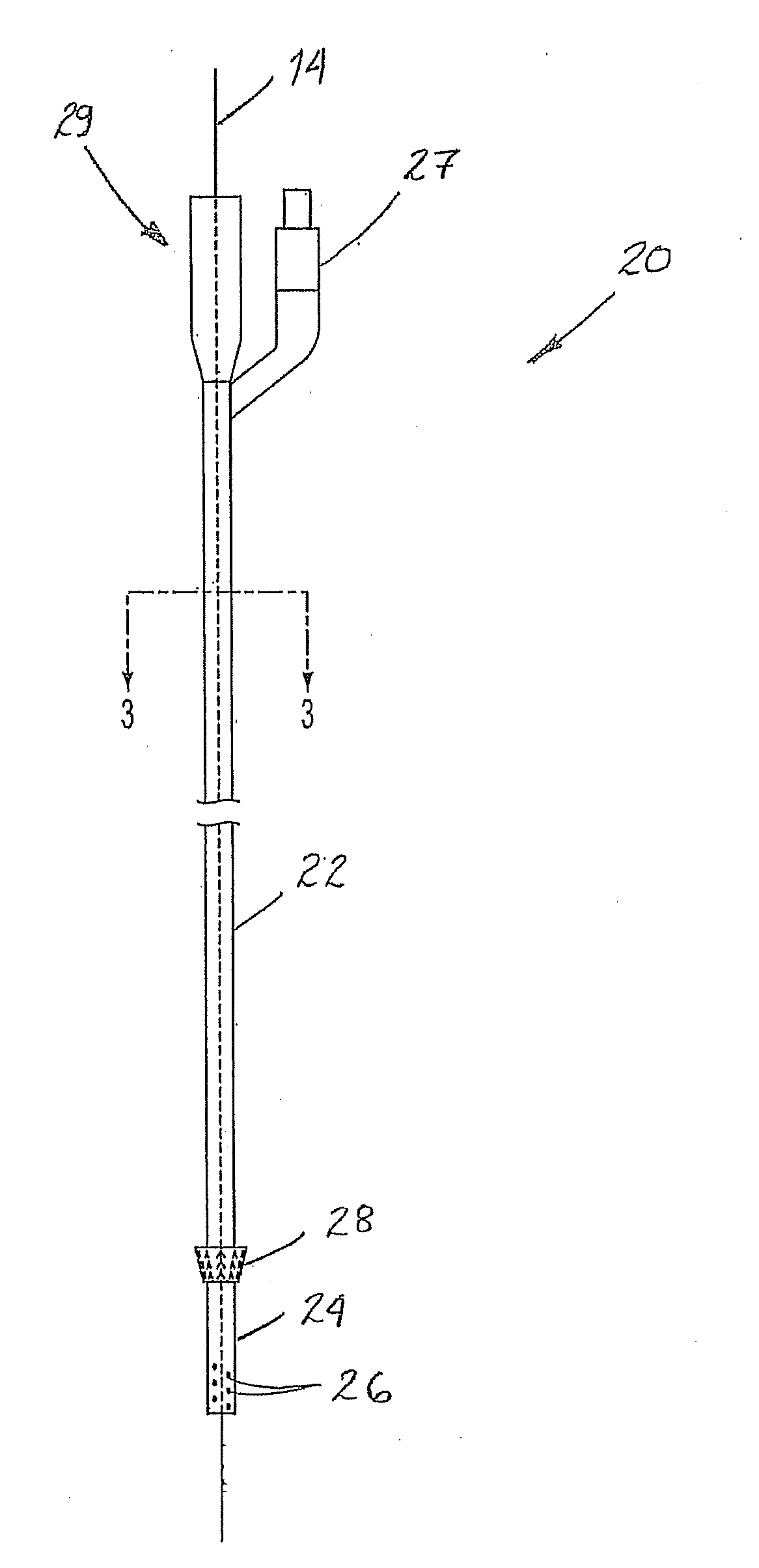 Venous closure catheter and method for sclerotherapy