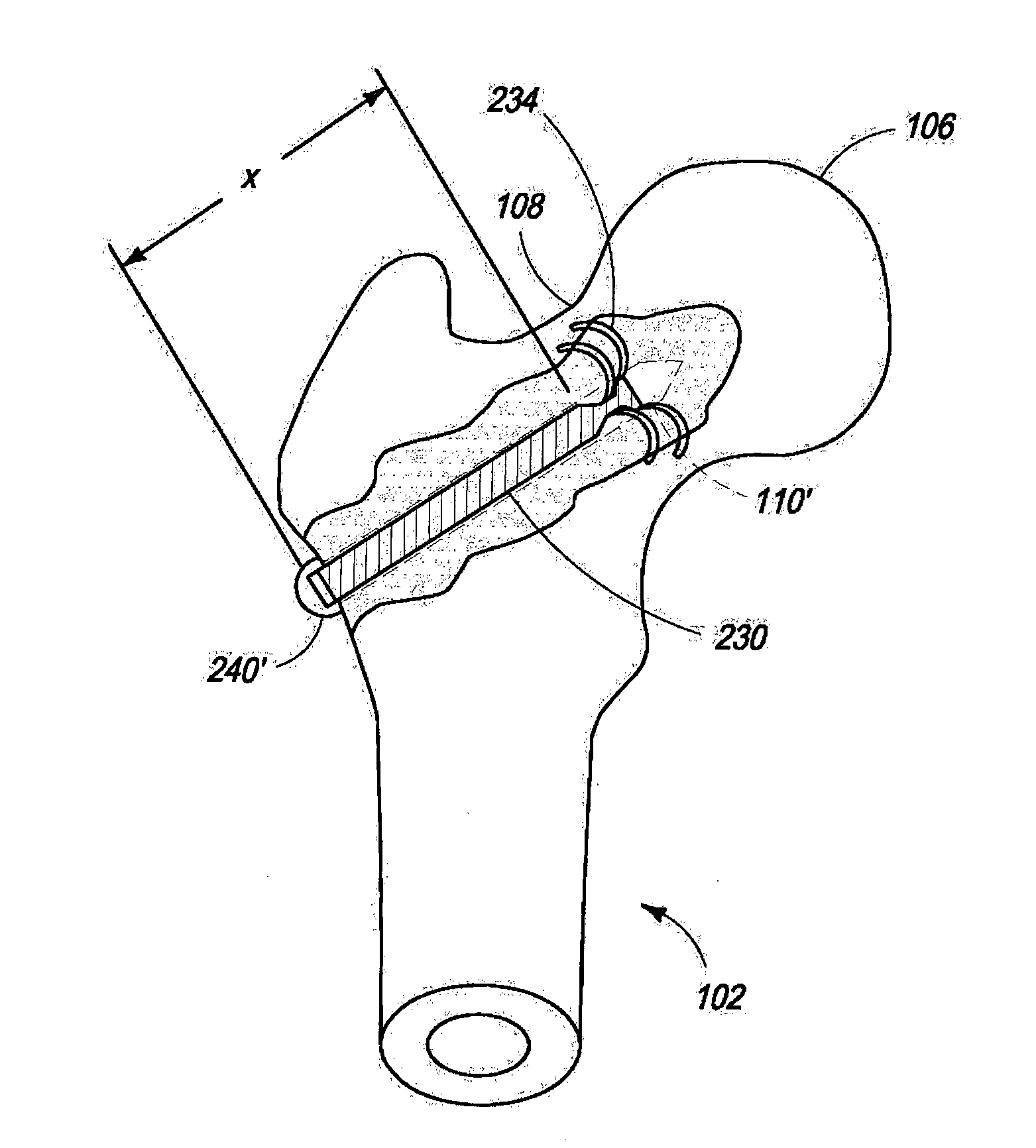 Hip implant