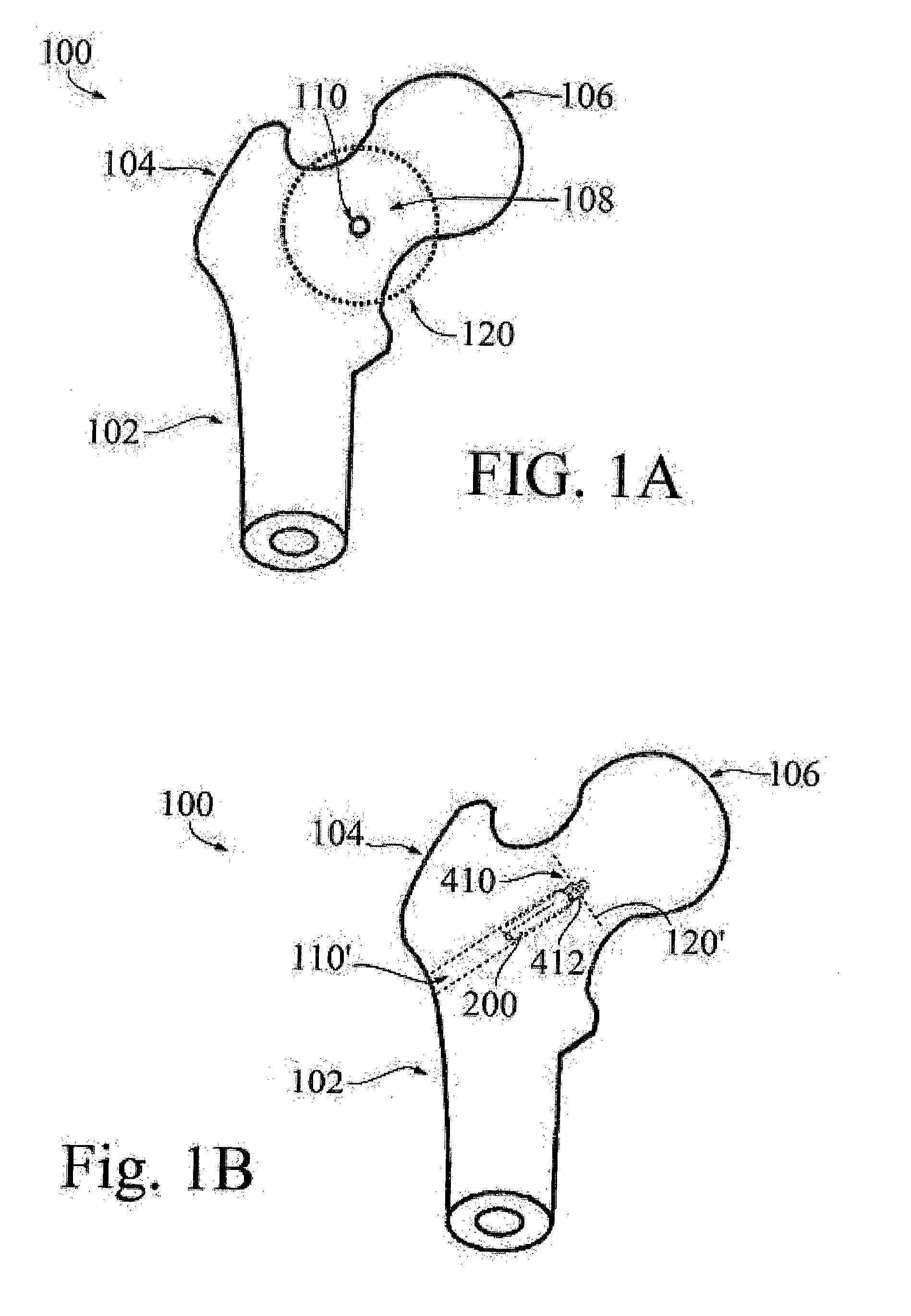 Hip implant