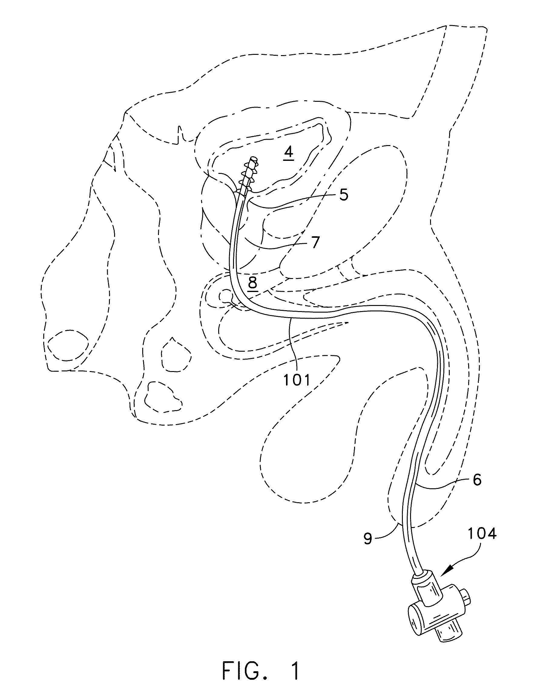 Rotate-to-advance catheterization system