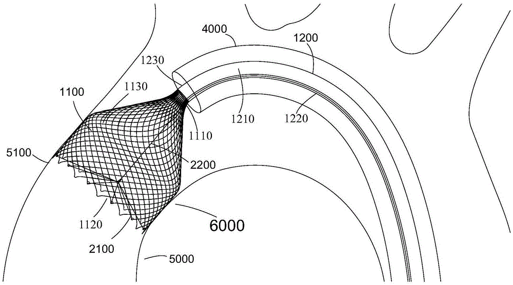 Thrombus filter