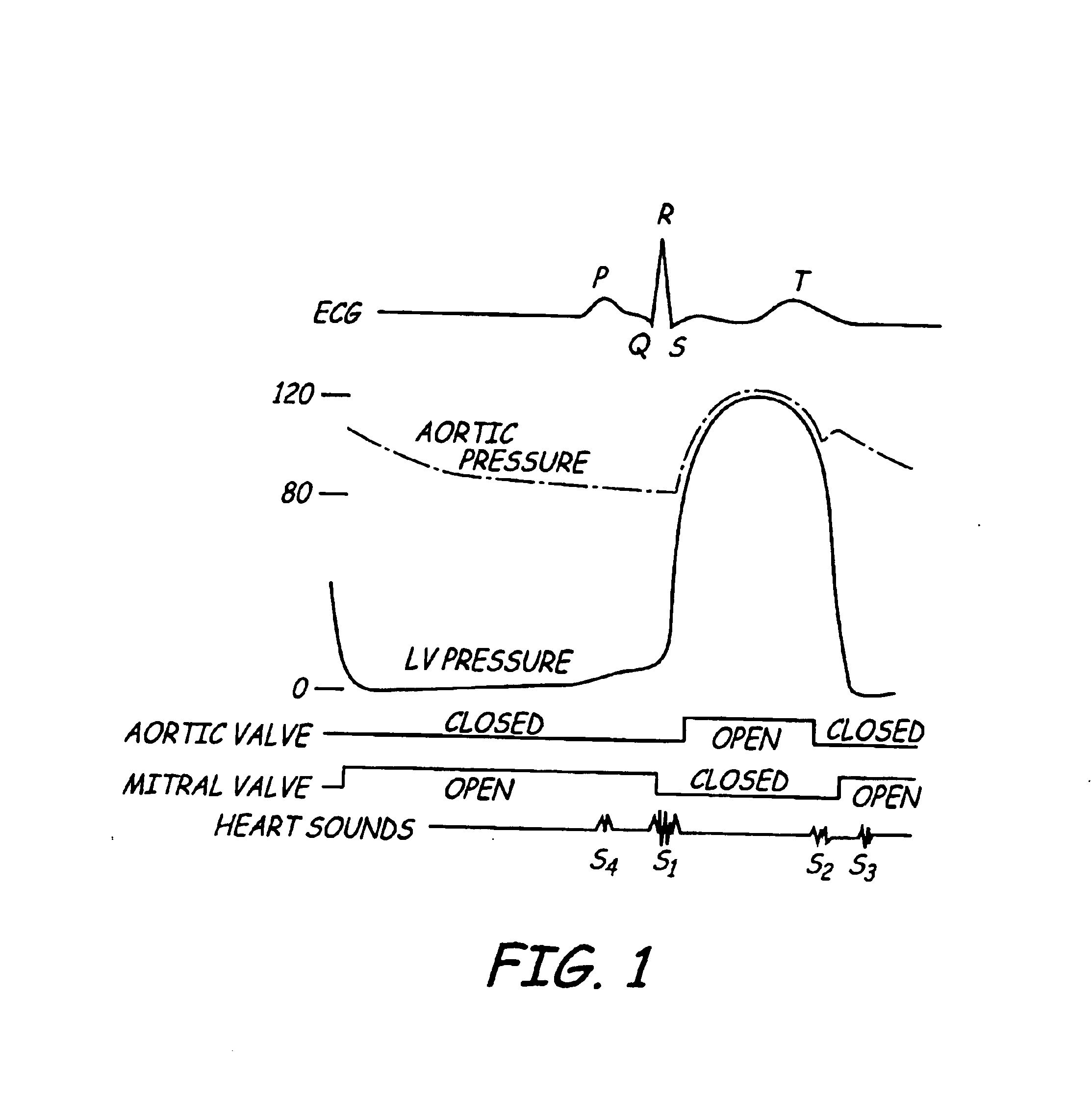 Apparatus and method for chronically monitoring heart sounds for deriving estimated blood pressure