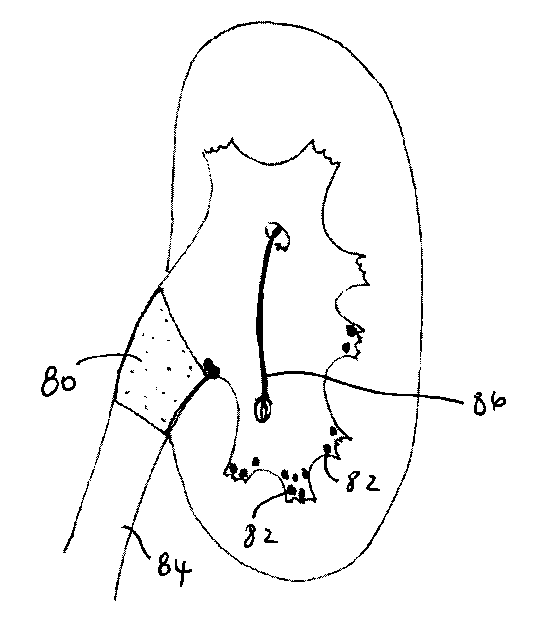 Methods and apparatus for temporarily occluding body openings