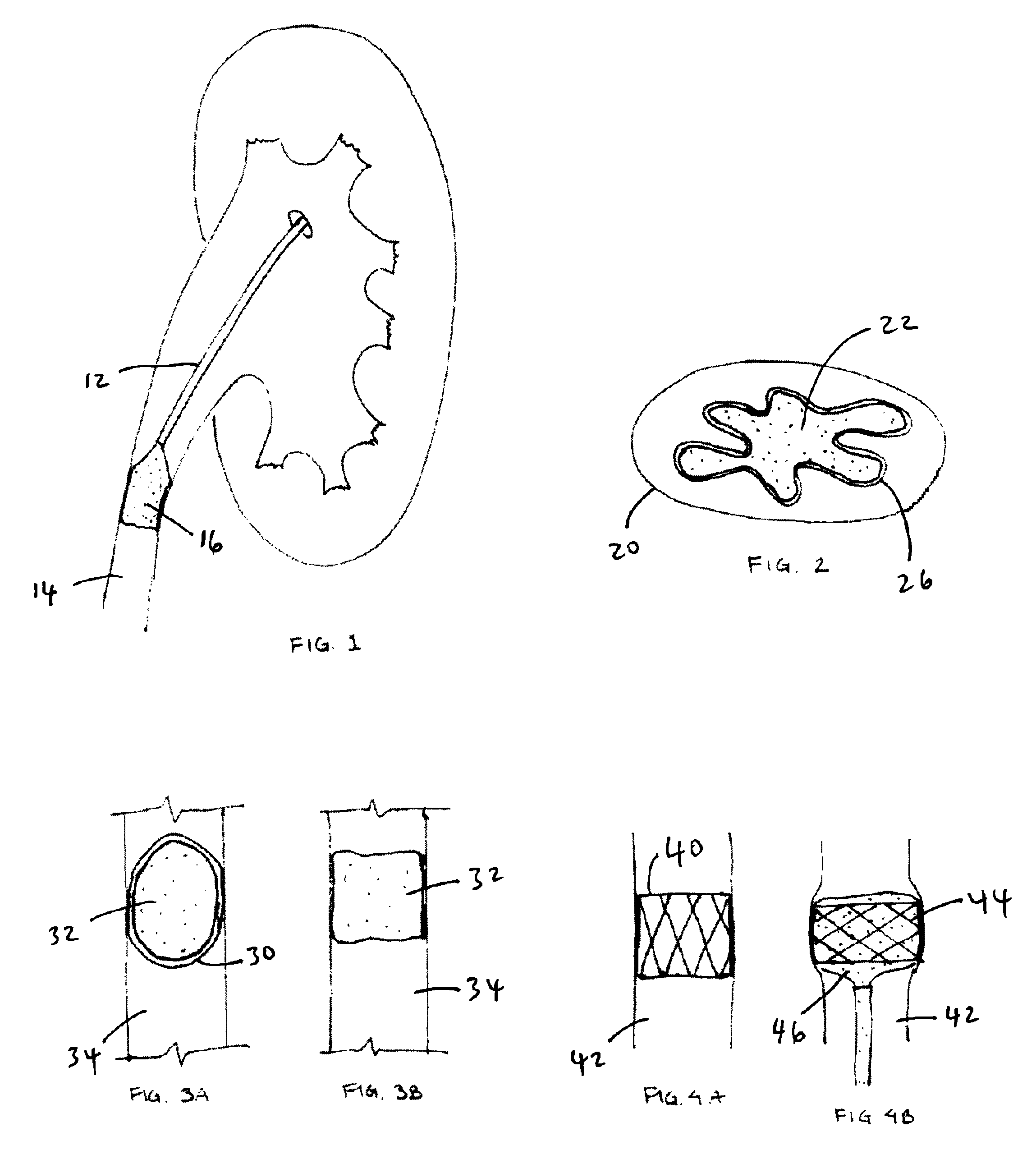 Methods and apparatus for temporarily occluding body openings