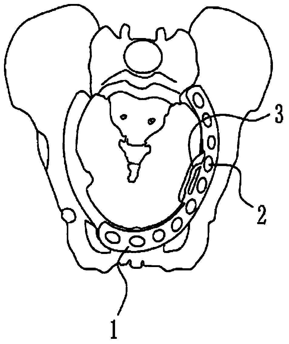 Acetabular compression plate with dual cortical fixation and method of fixing thereof