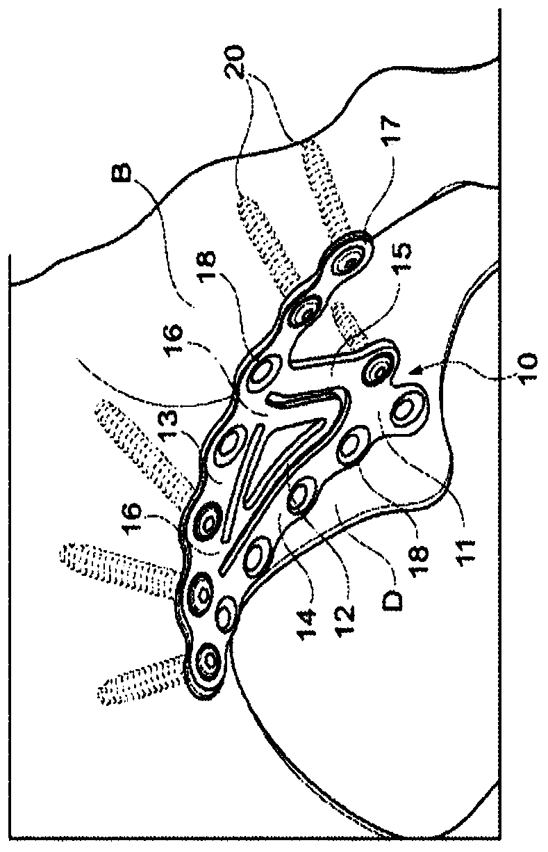 Acetabular compression plate with dual cortical fixation and method of fixing thereof