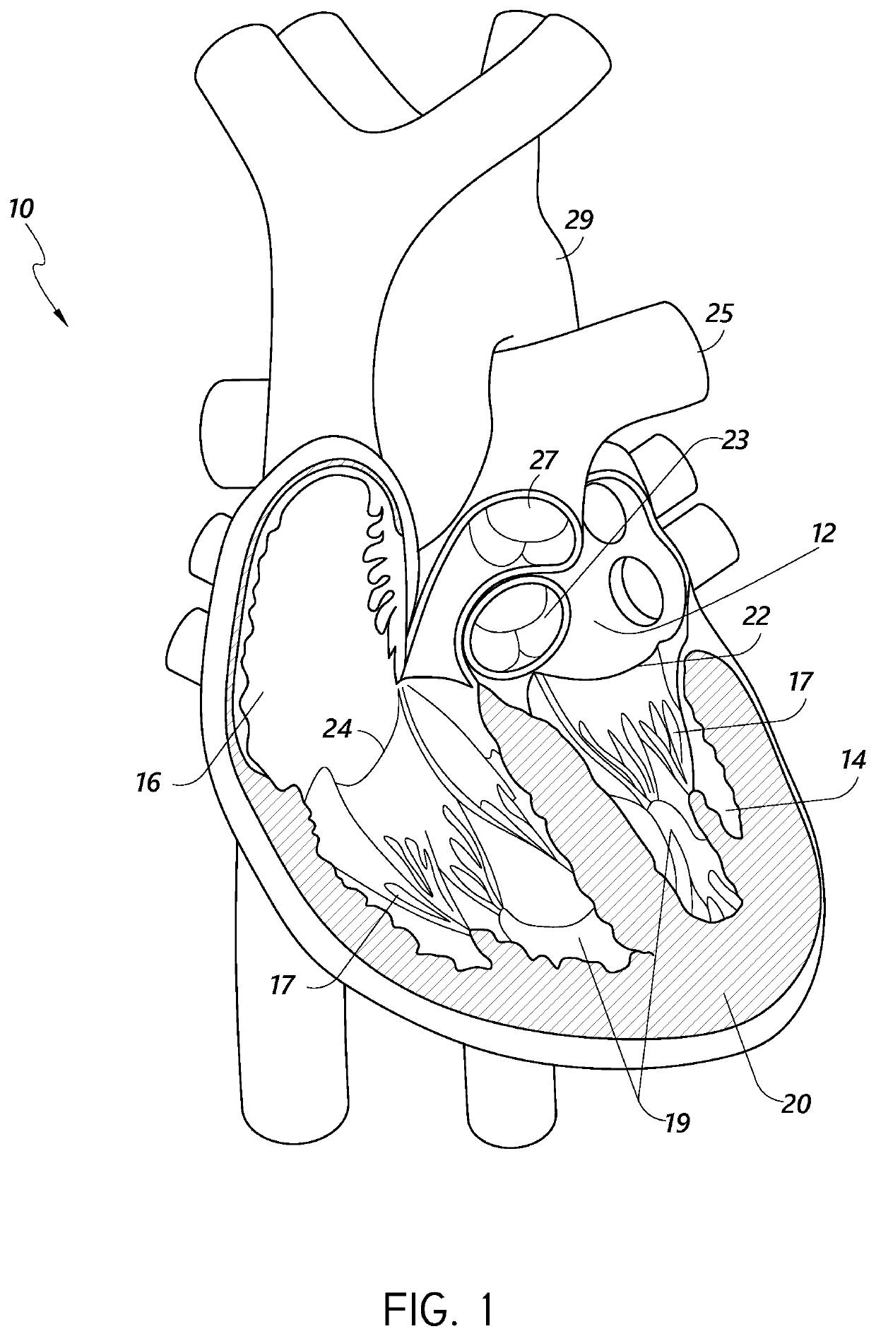 Implanting grafts to valve leaflets for cardiac procedures