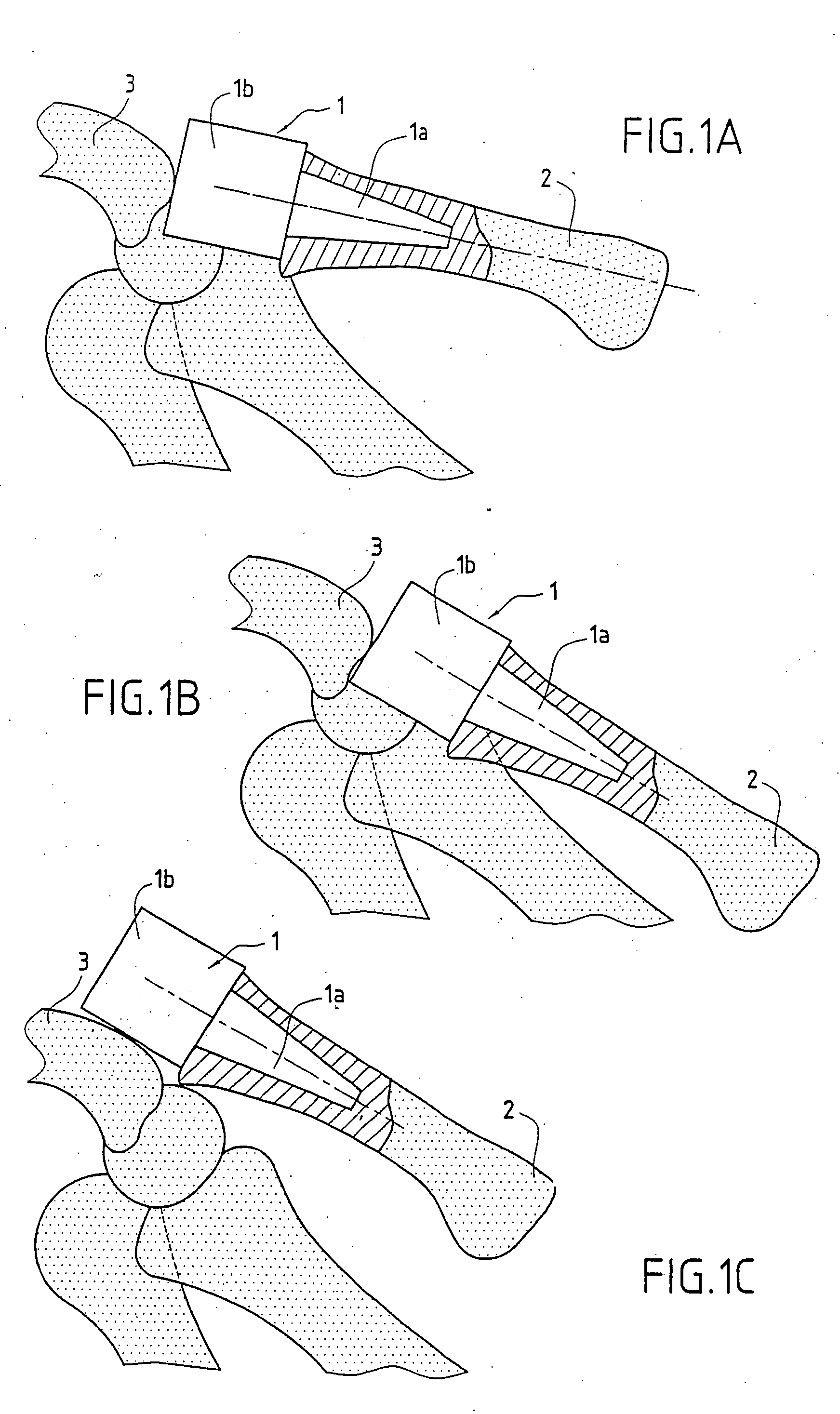 Trapezal or trapezo-metacarpal implant