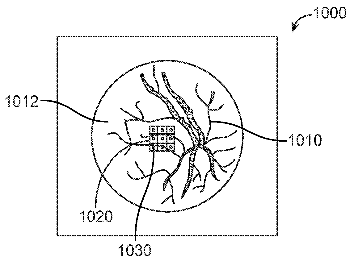 Grid pattern laser treatment and methods