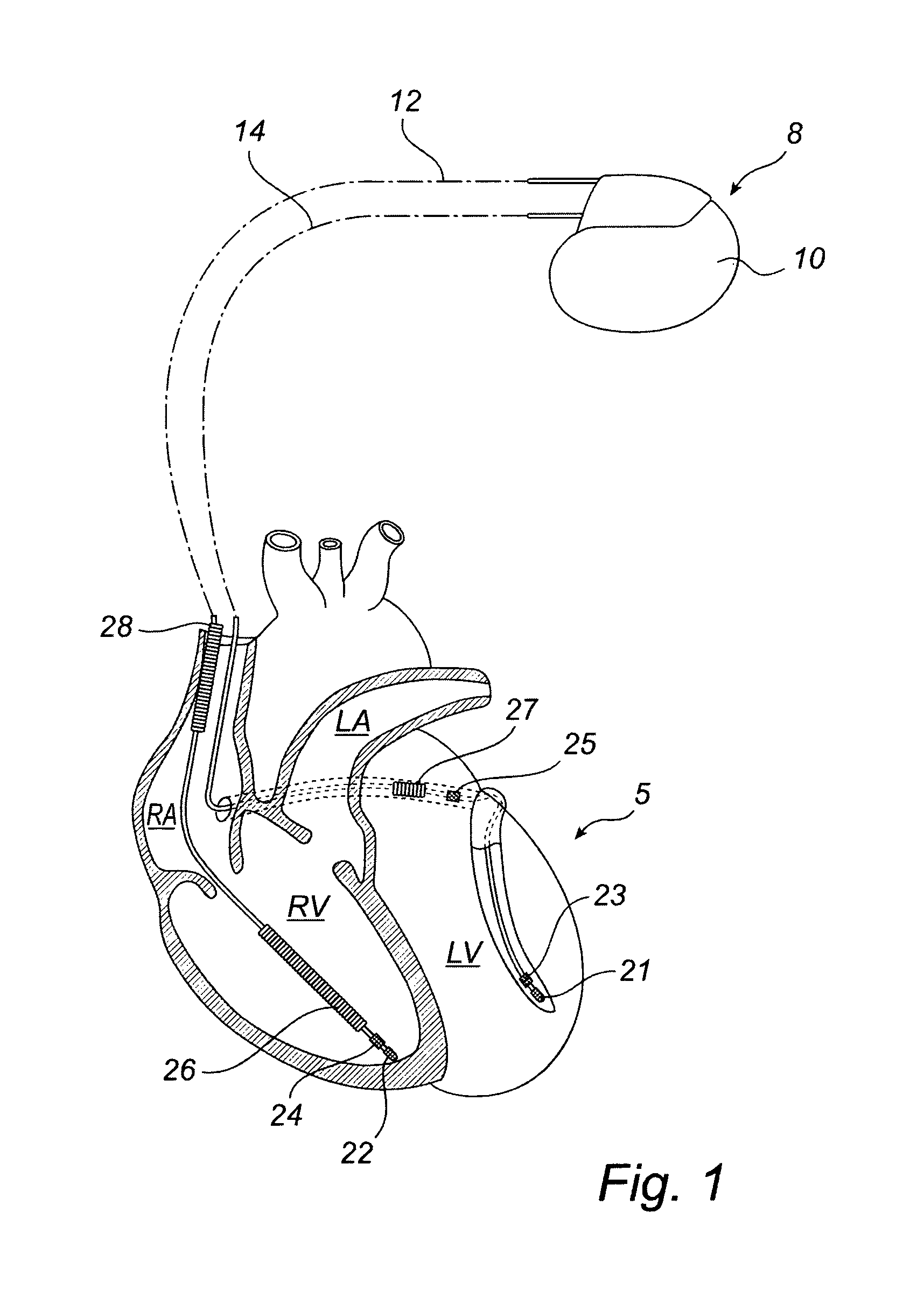 Devices and method for determining and monitoring a cardiac status of a patient by using PLVDT or PLVST parameters