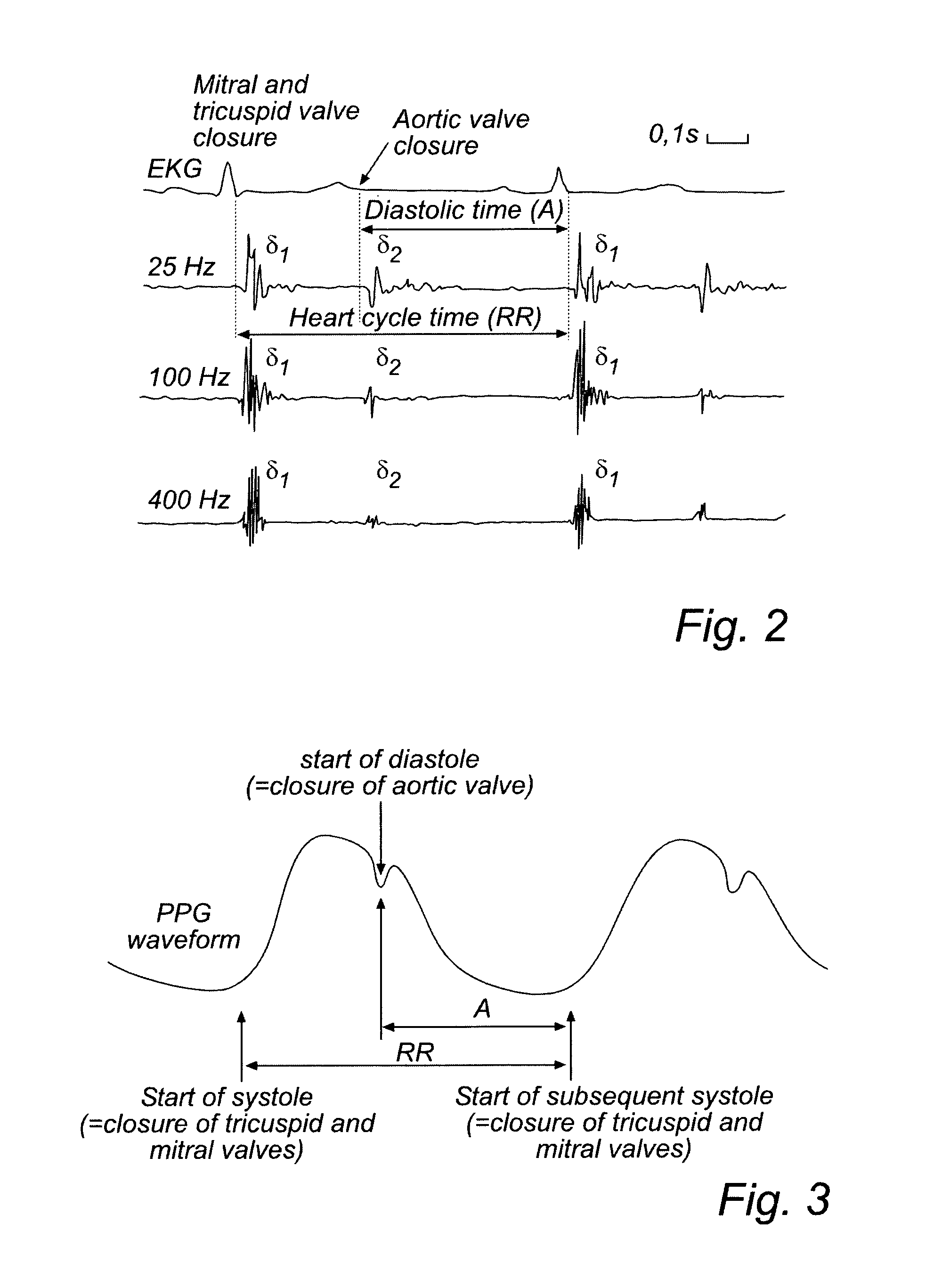 Devices and method for determining and monitoring a cardiac status of a patient by using PLVDT or PLVST parameters