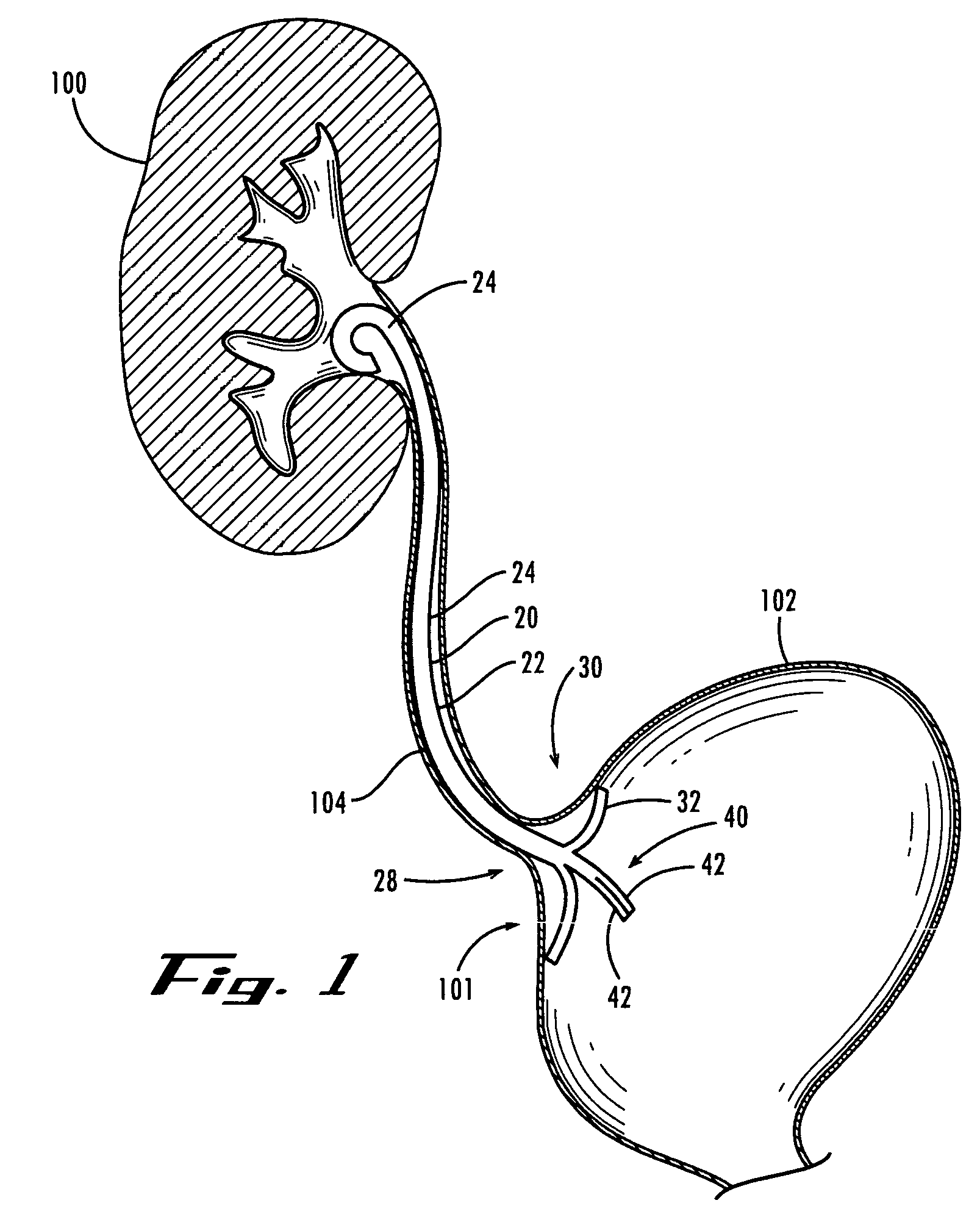 Ureteral stent