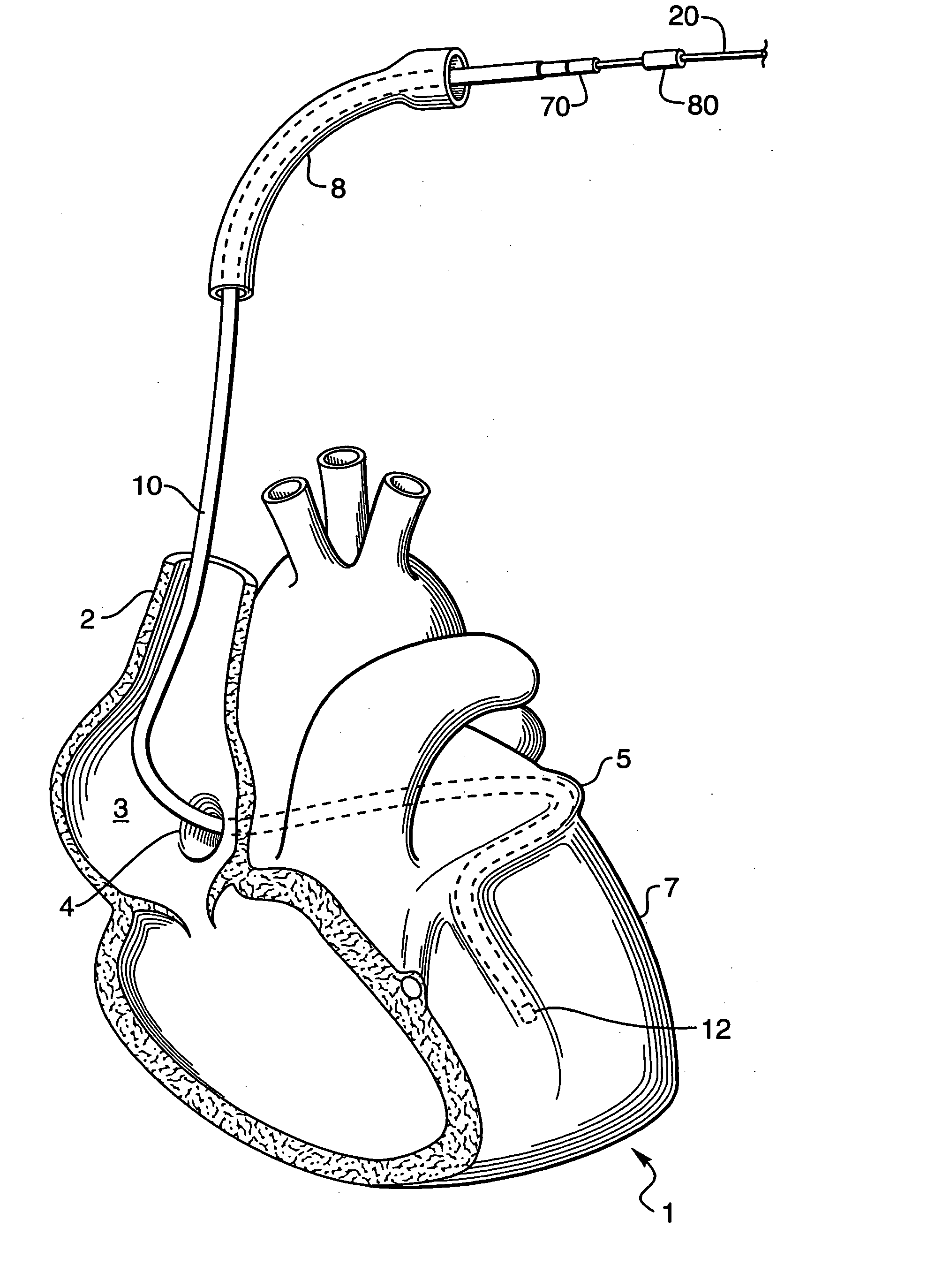 Modified guidewire for left ventricular access lead