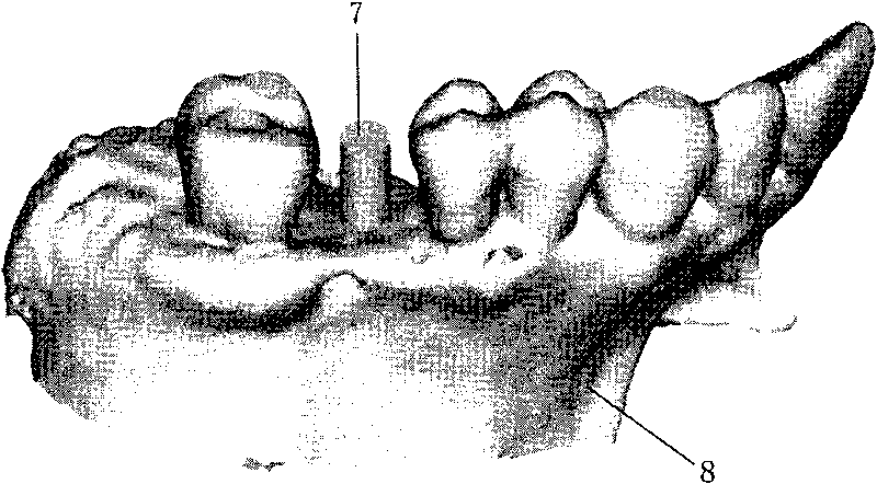 Personalized positioning navigation system for dental implantation