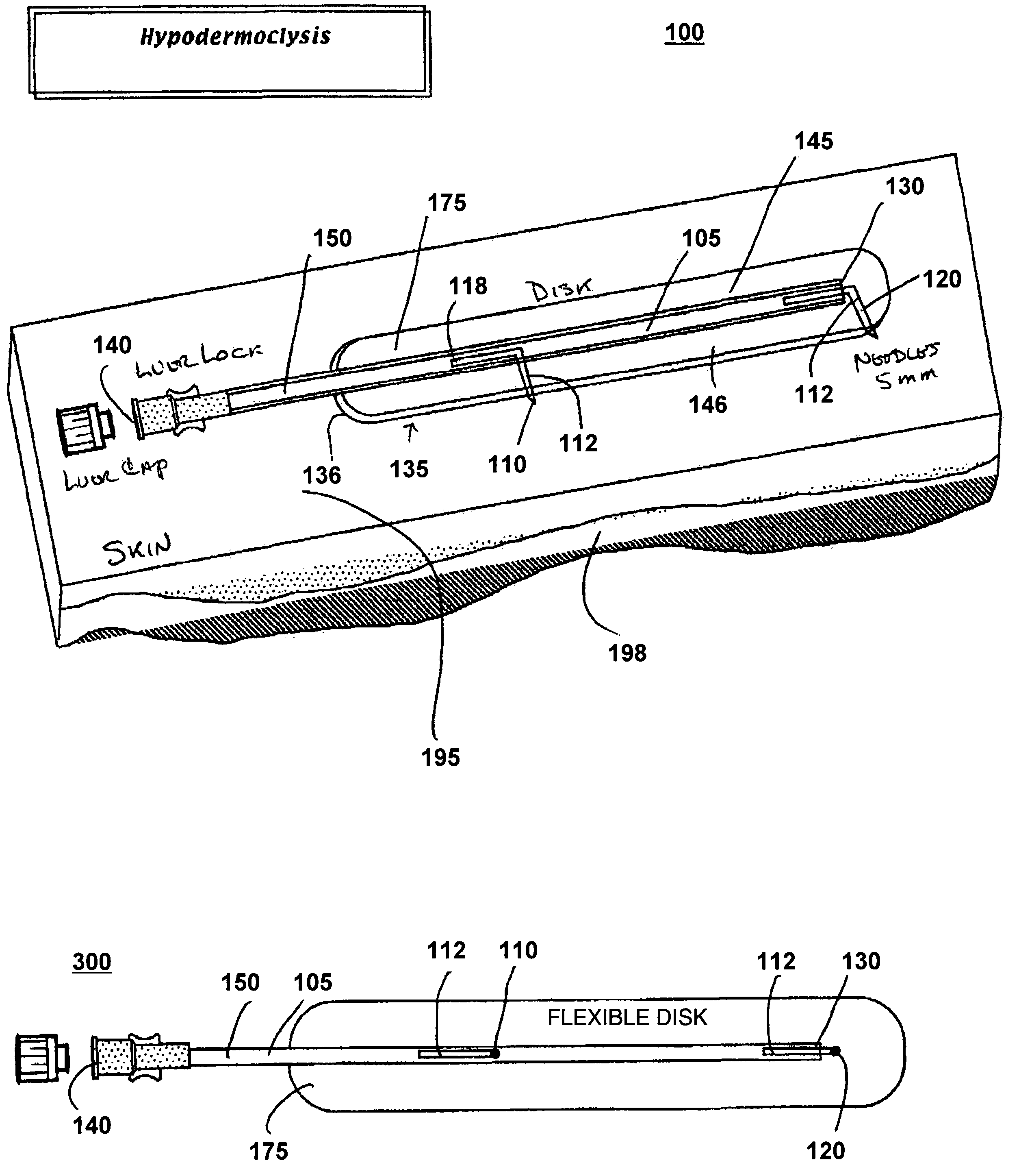 Device for subcutaneous infusion of fluids