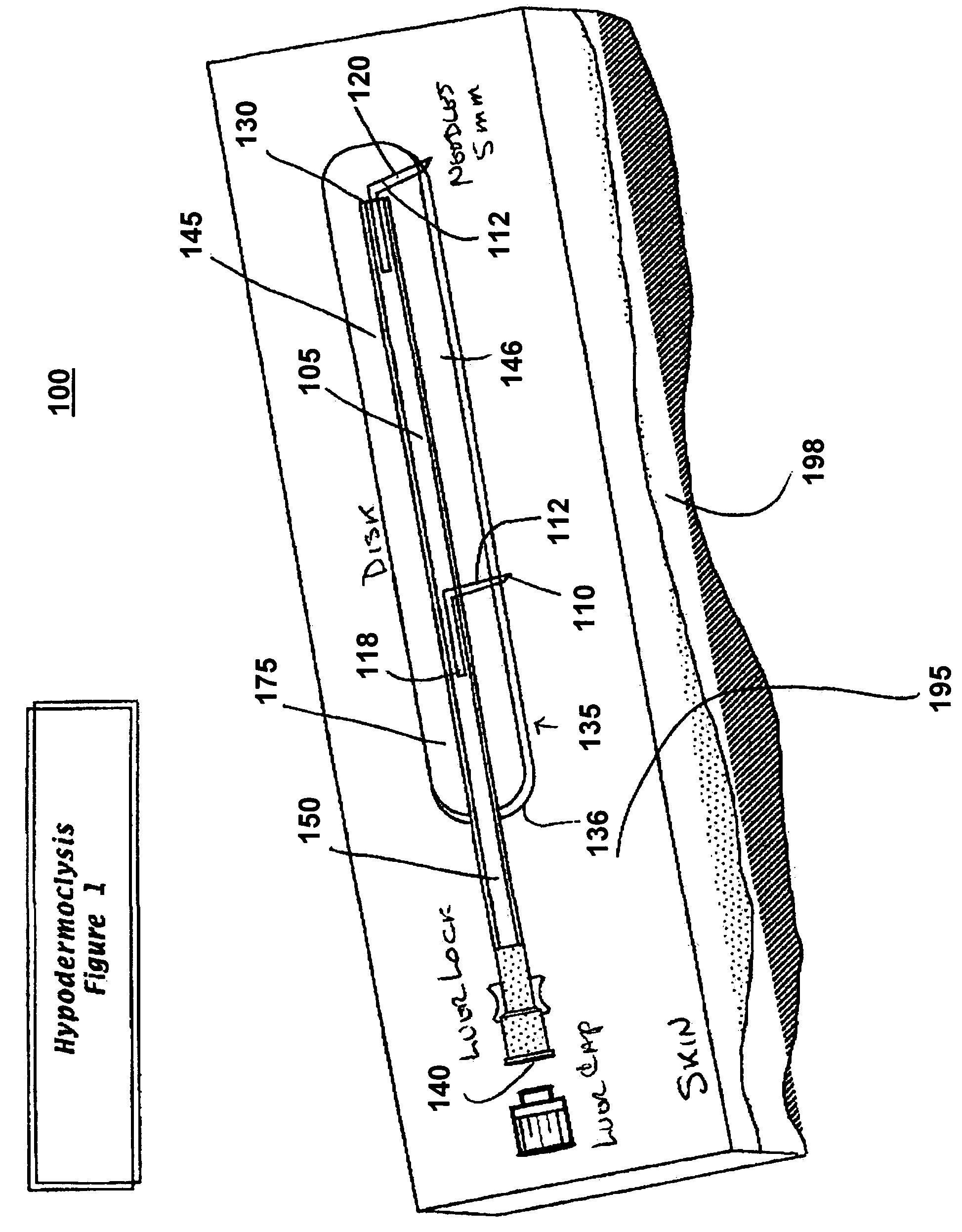 Device for subcutaneous infusion of fluids