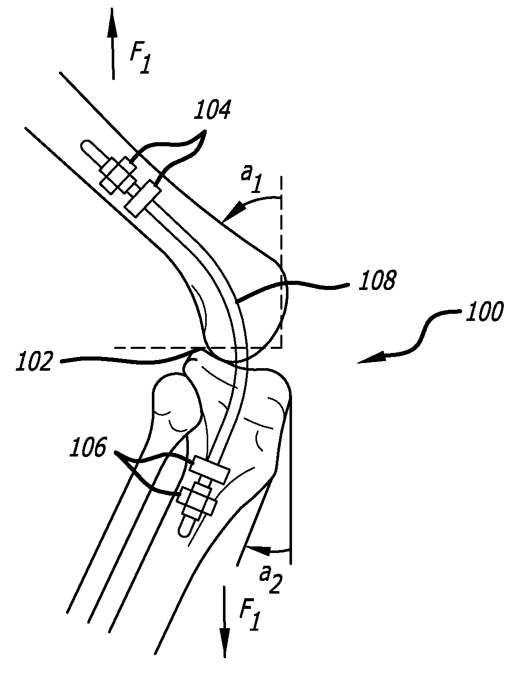 Extra-Articular Implantable Mechanical Energy Absorbing Systems