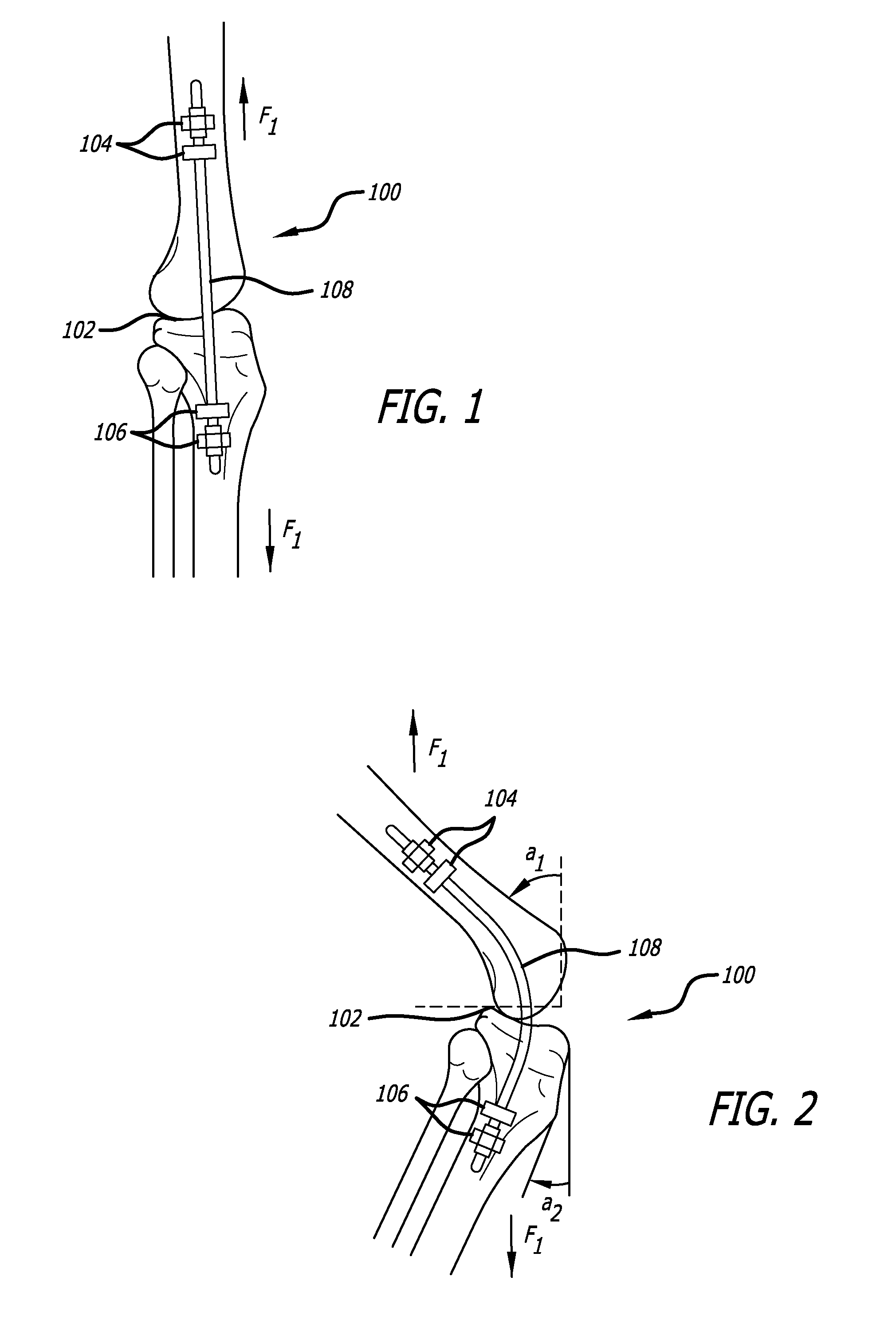 Extra-Articular Implantable Mechanical Energy Absorbing Systems