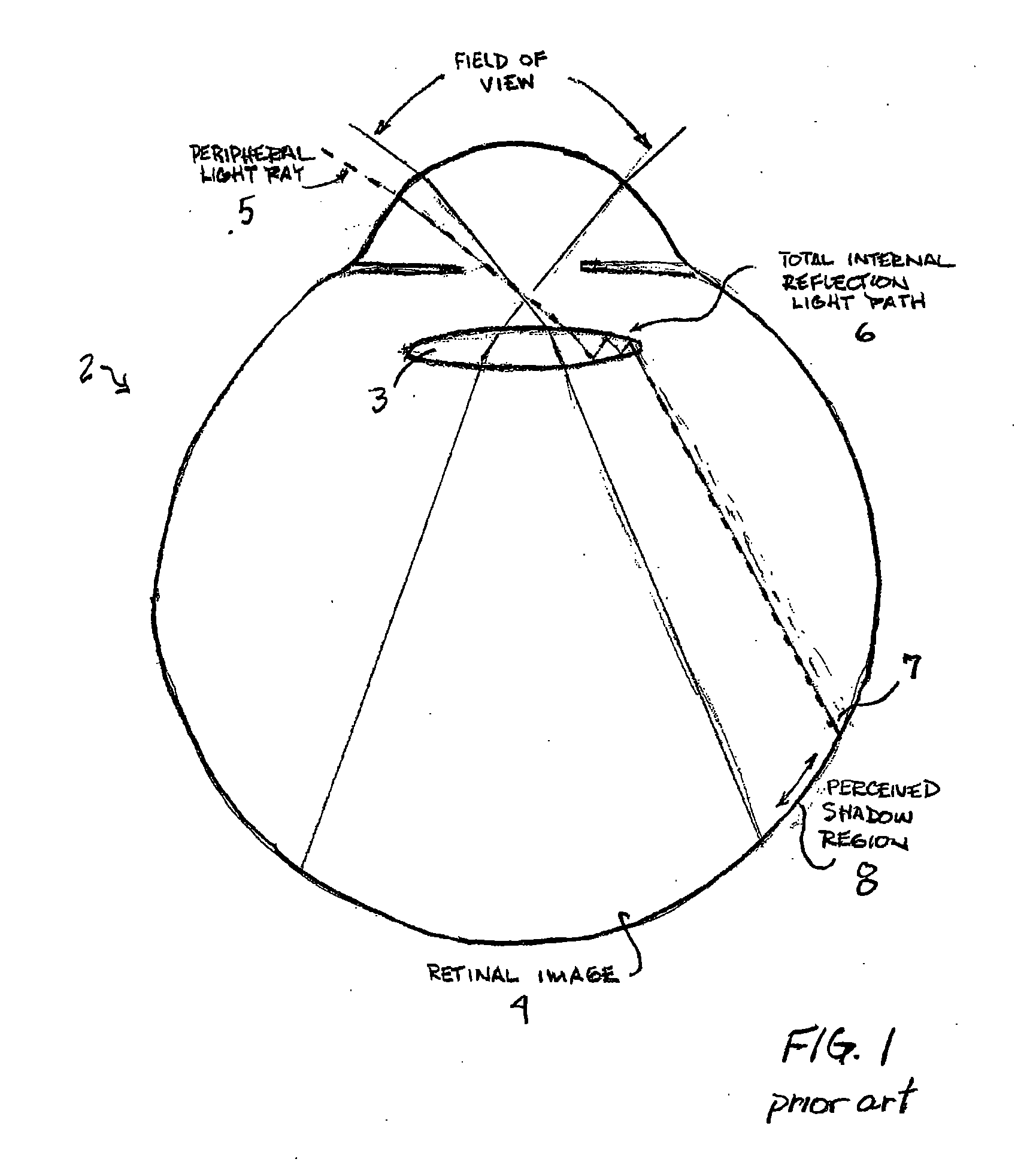 Intraocular lens with edge modification