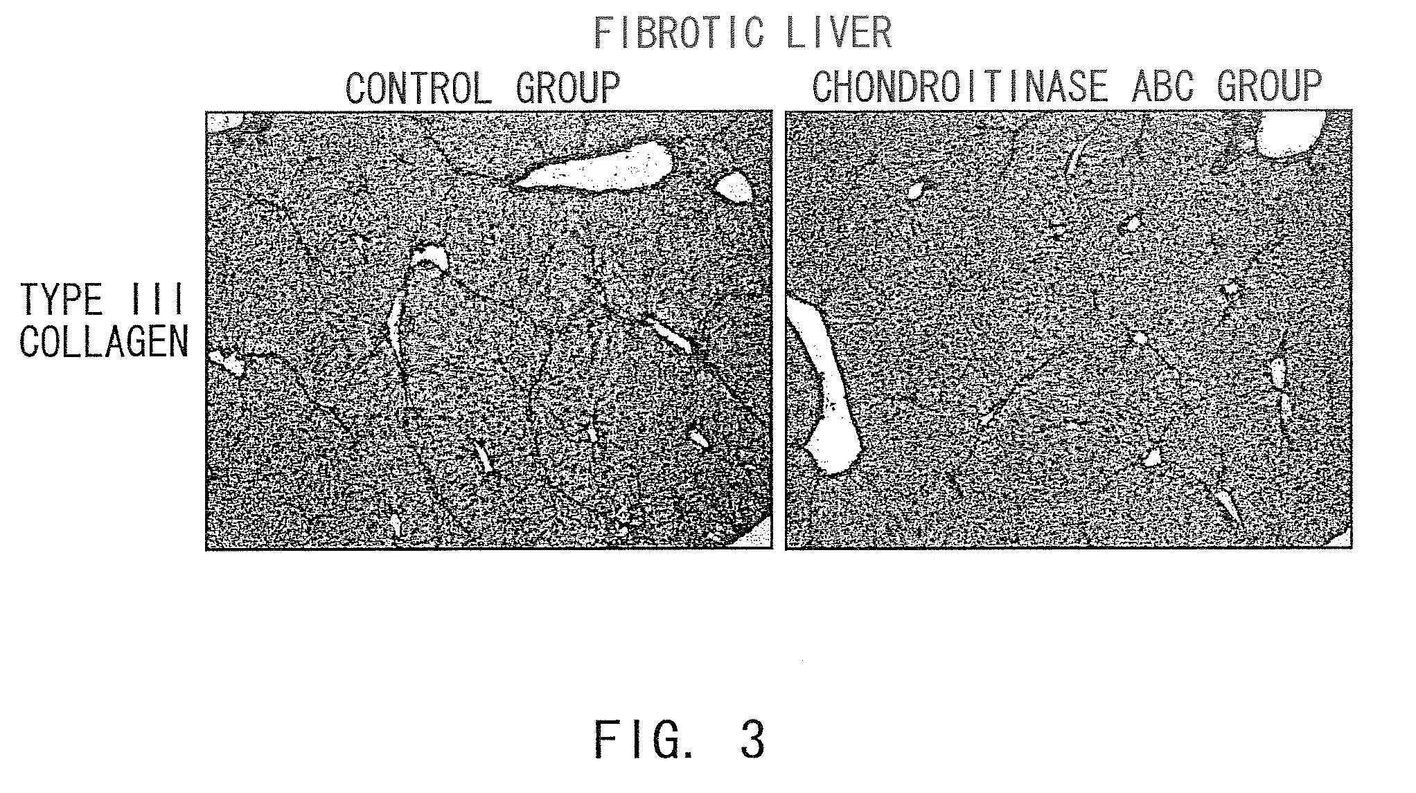 Agents for suppressing hepatic fibrosis