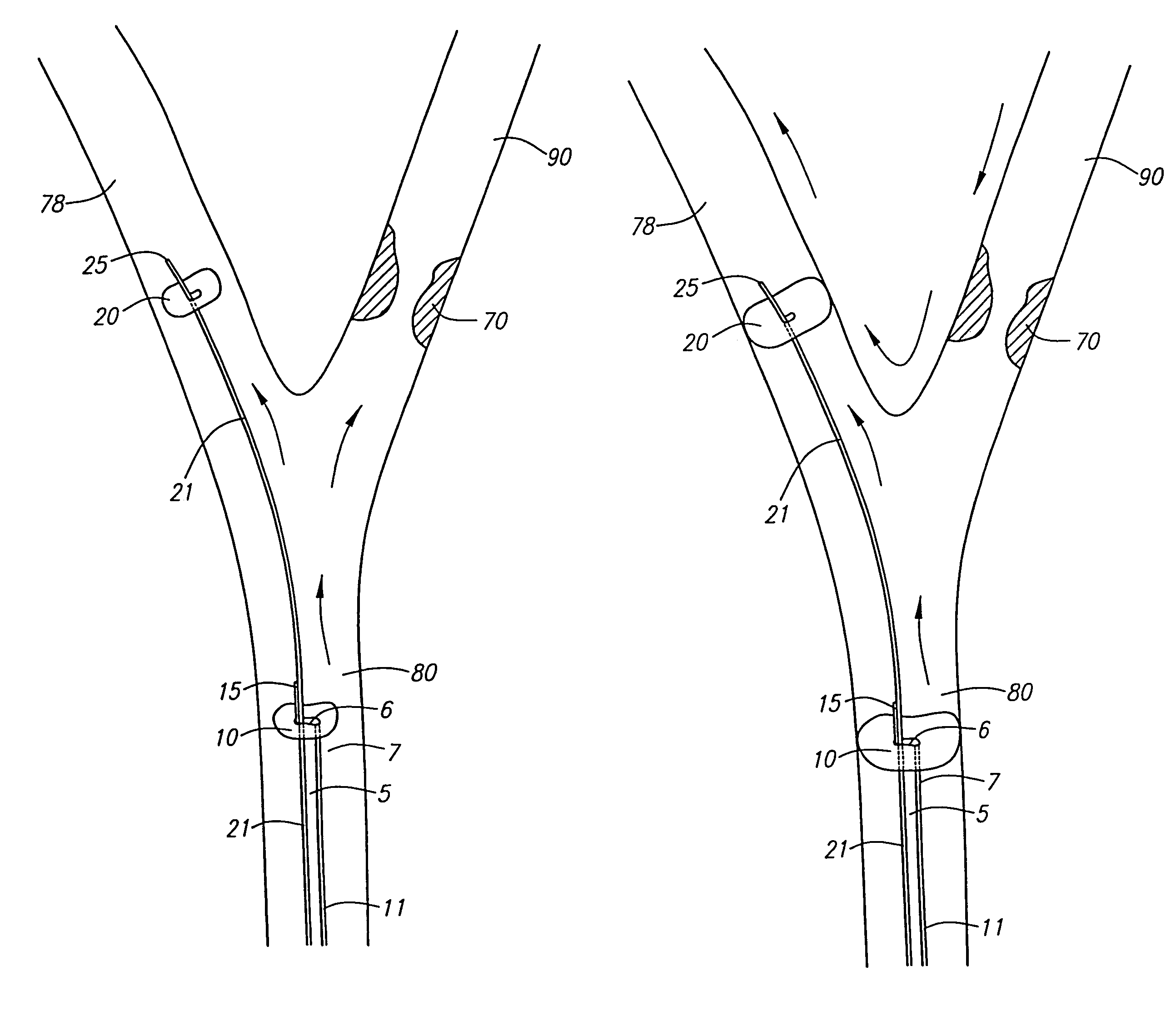 Devices and methods for preventing distal embolization during interventional procedures