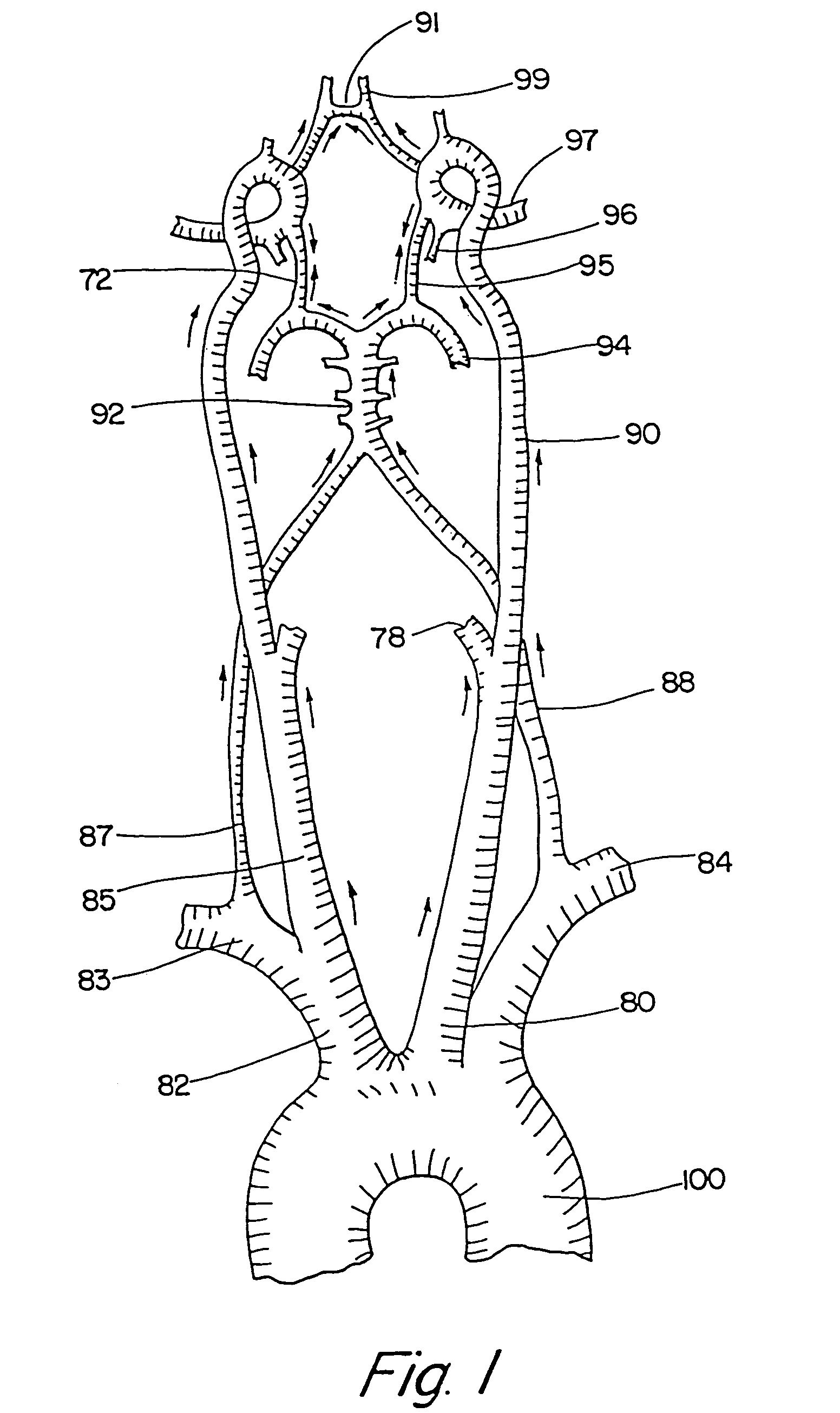 Devices and methods for preventing distal embolization during interventional procedures