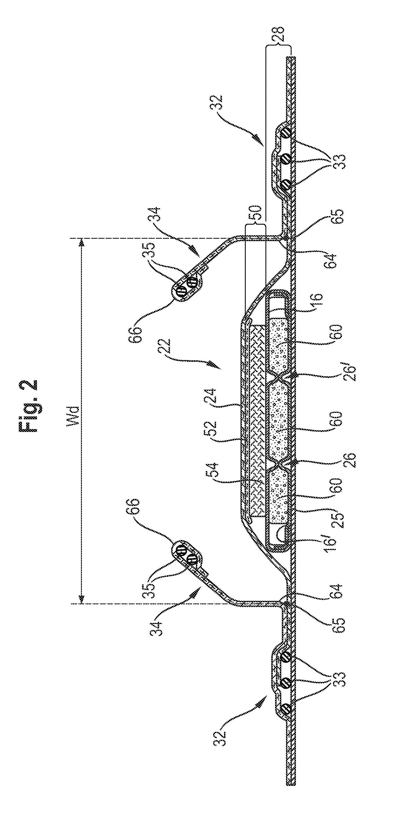 Absorbent article with high absorbent material content