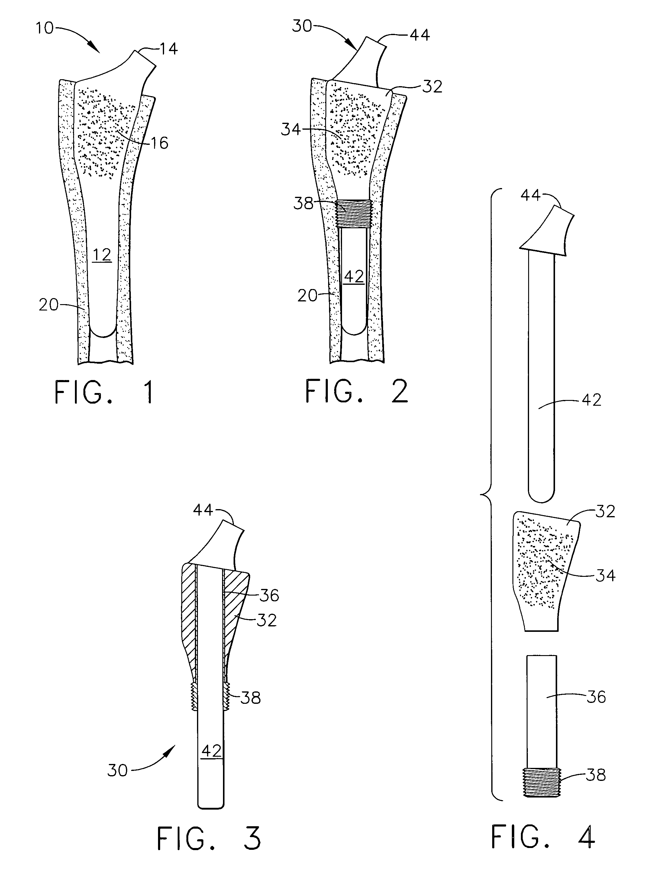 Expanding arthroplasty devices