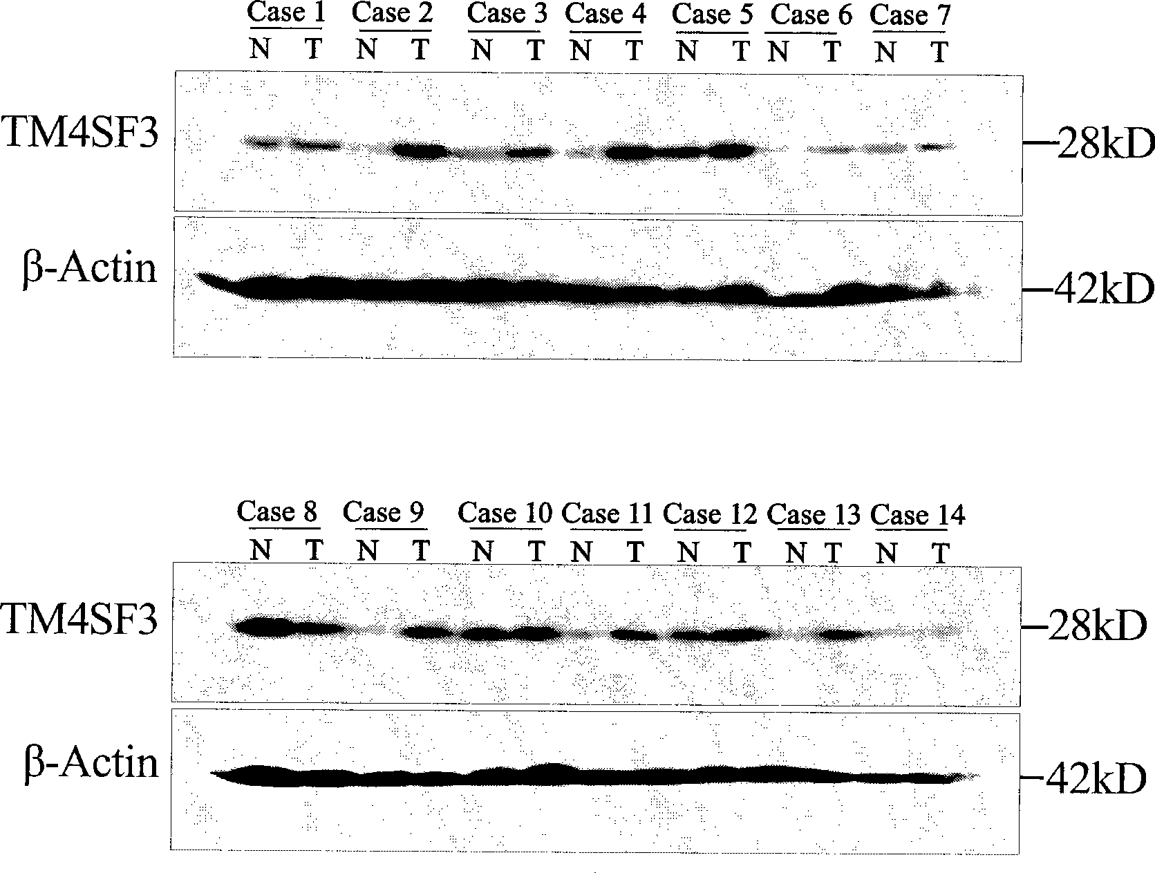 TM4SF3 protein for preparing antineoplastic antibody and use thereof