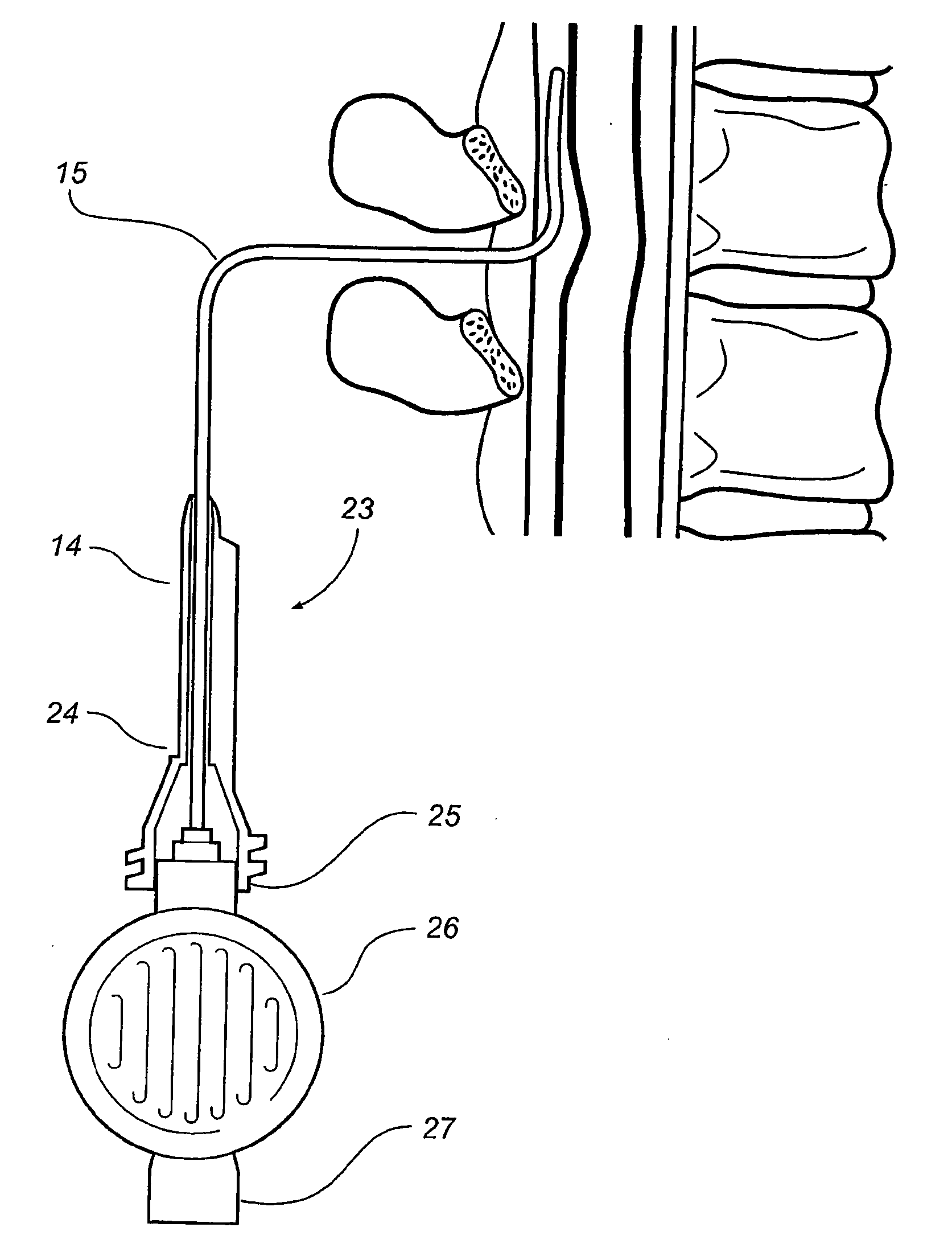 Epidural administration systems