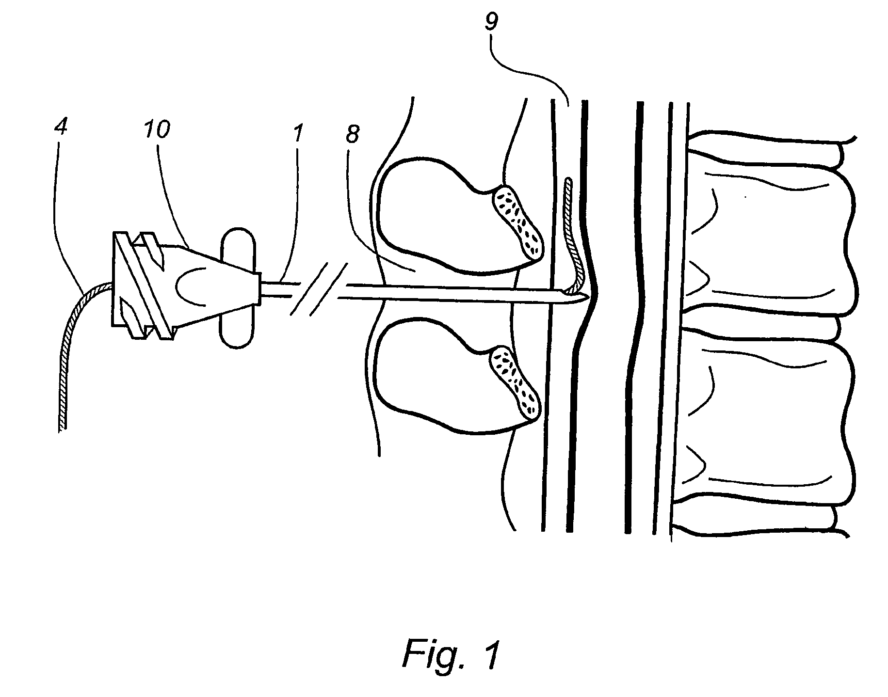 Epidural administration systems