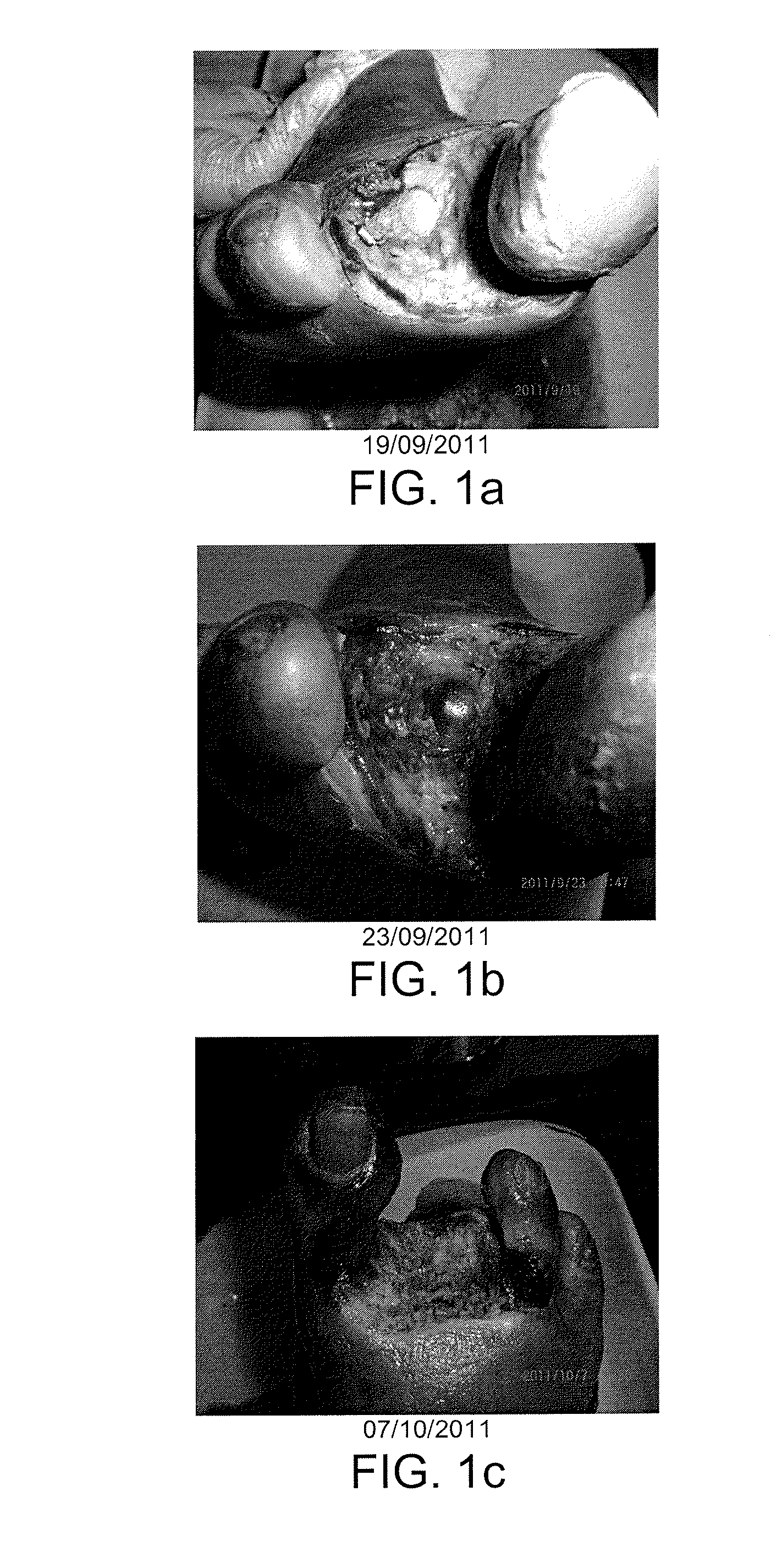 Compositions for the debridement, granulation and reepithelialization of wounds in man