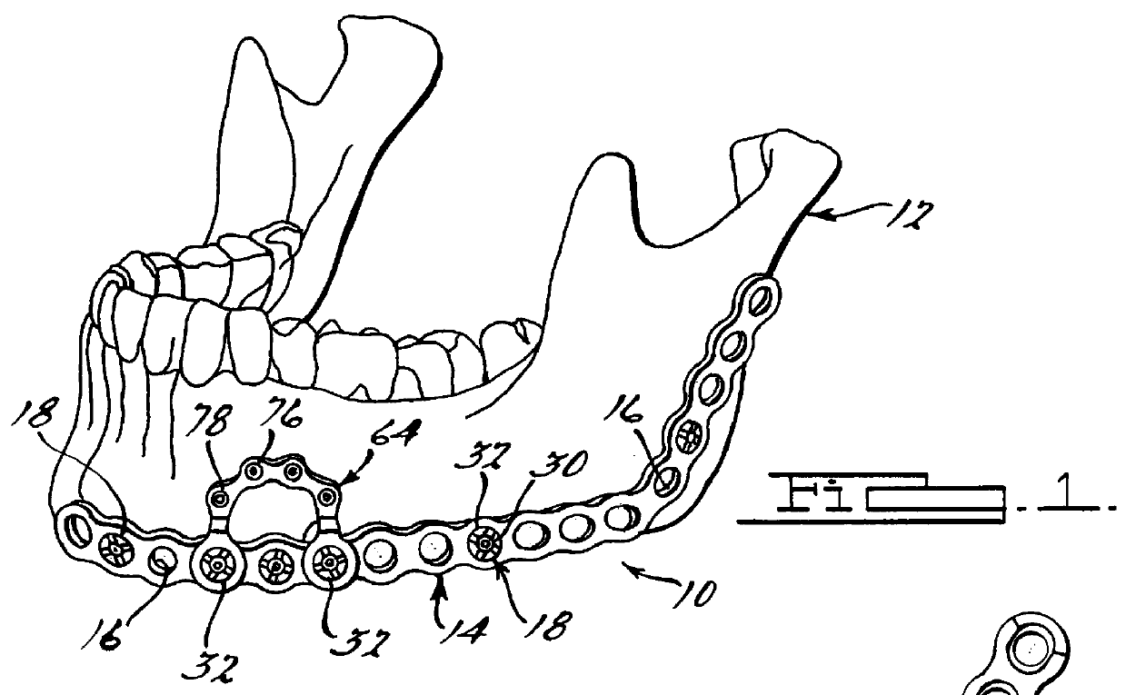 Method and apparatus for mandibular osteosynthesis