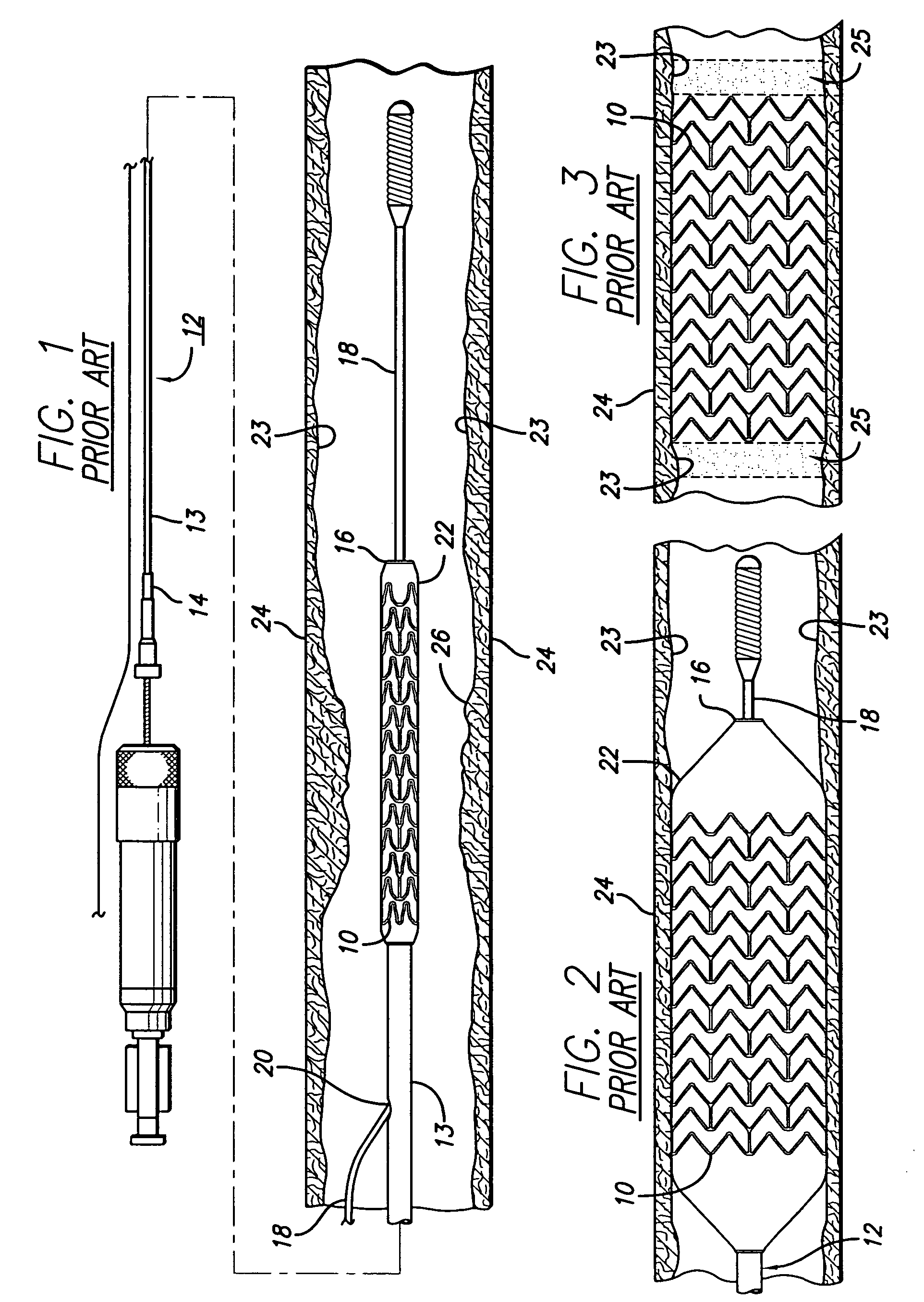 Intravascular stent with extendible end rings