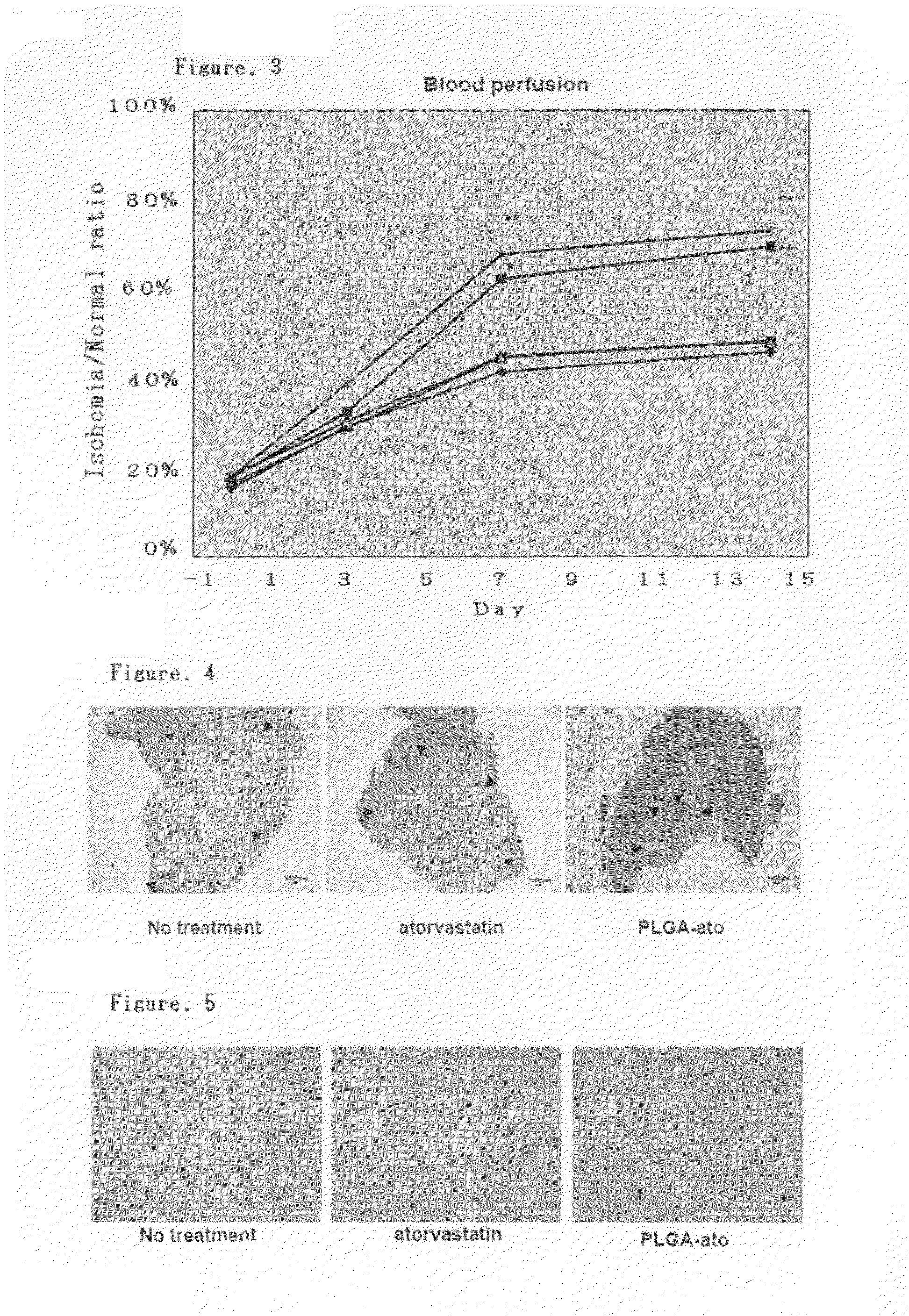 Pharmaceutical composition containing statin-encapsulated nanoparticle